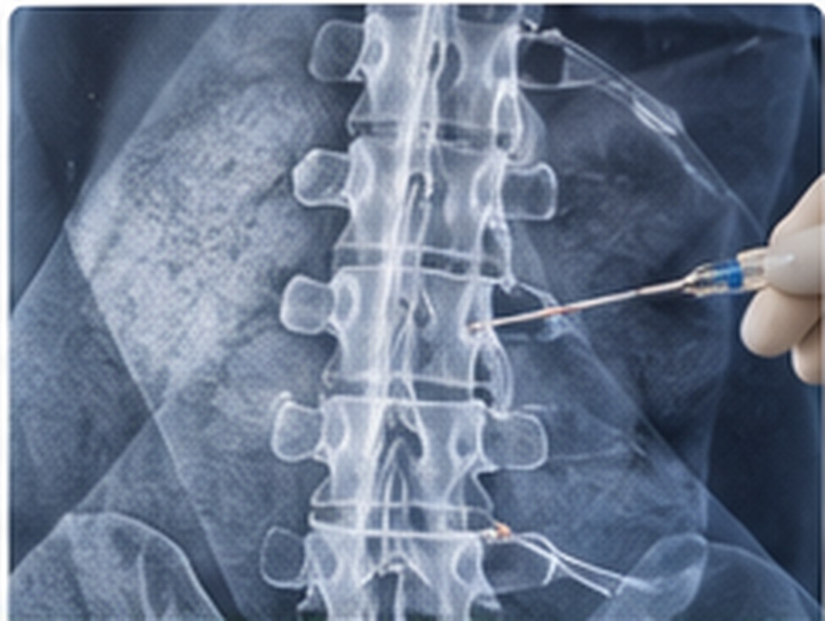 X-ray of Spine with Needle Injection for Pain Management Therapy