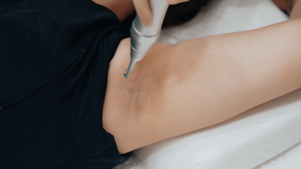 HYPERPIGMENTATION
