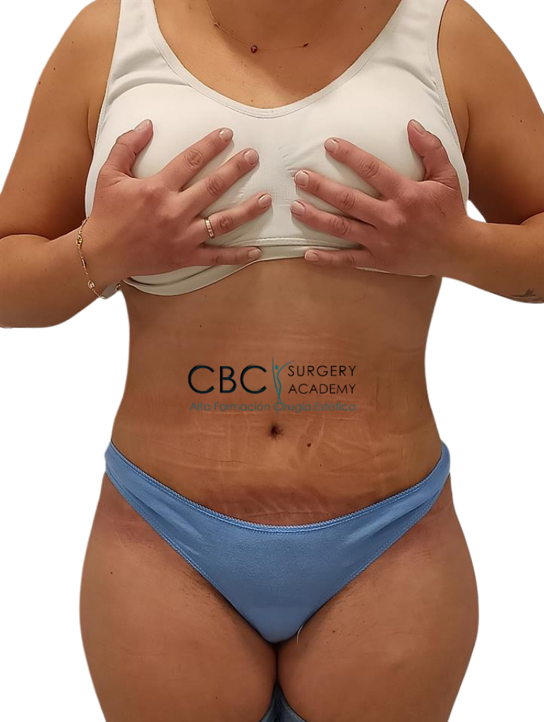 Resultado a los 6 meses: pared abdominal firme y cicatrización completa tras dehiscencia central.