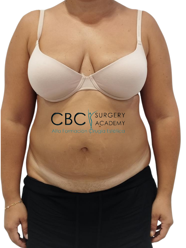 Paciente de 36 años con diástasis de rectos severa y hernia umbilical antes de abdominoplastia en CBC.