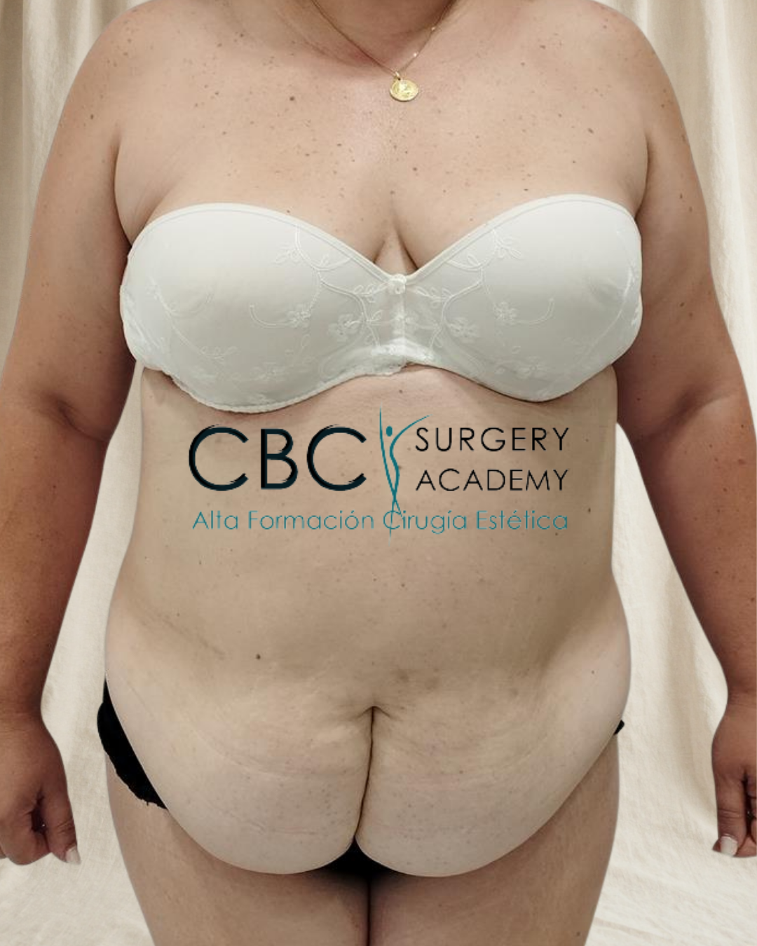 Antes abdominoplastia ampliada liposucción abdomen cintura espalda