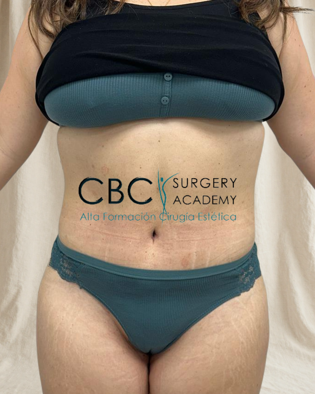 Después abdominoplastia ampliada liposucción 360°