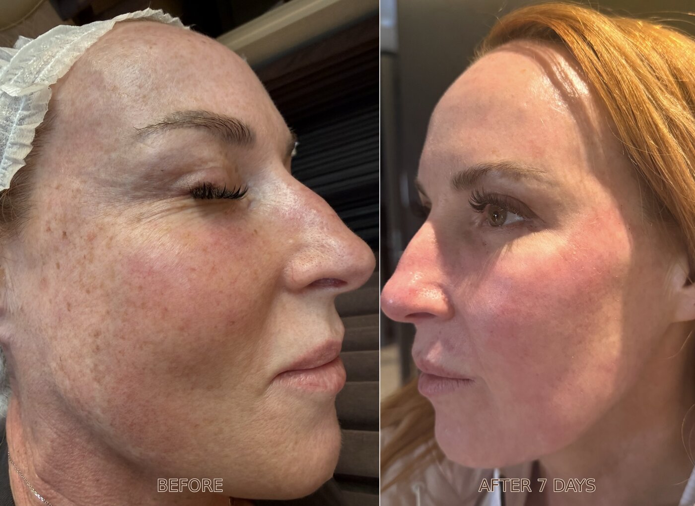 CO2 laser before and after result 2