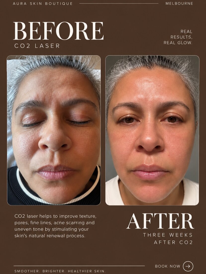 CO2 laser before and after result 3