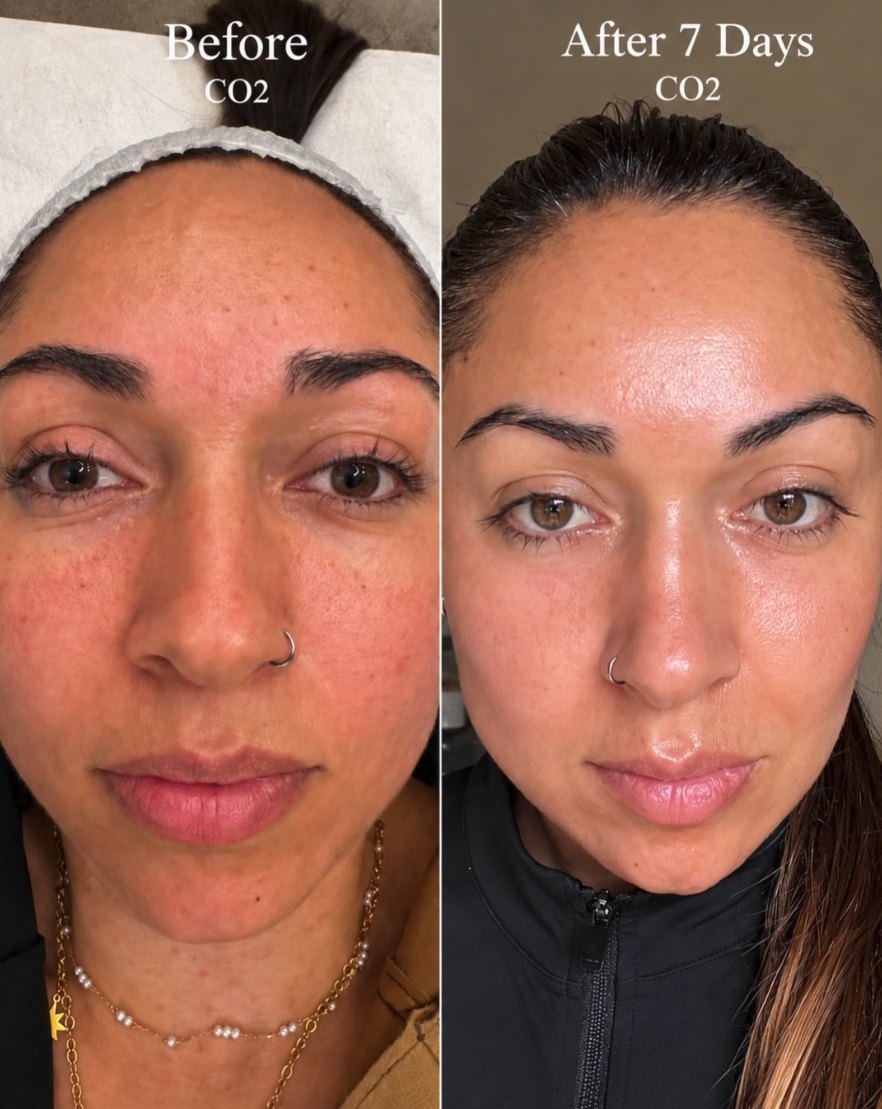 CO2 laser before and after result 6