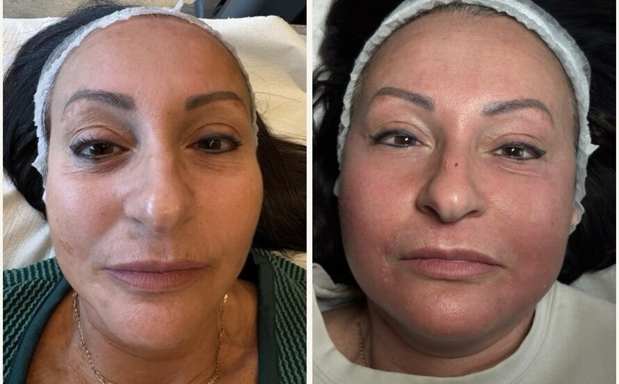 CO2 laser before and after result 1