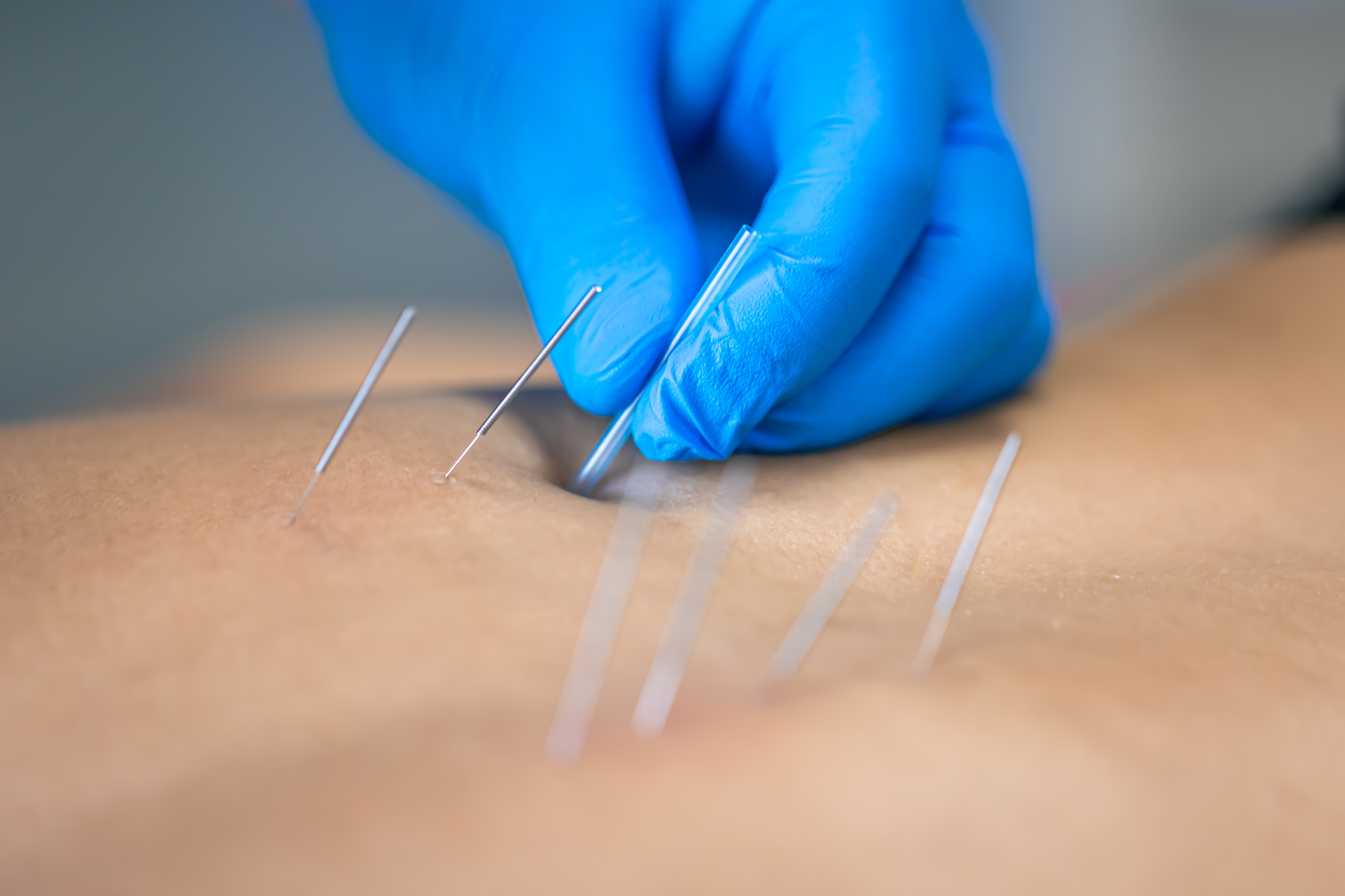 Acupuncture treatment at Monmouth Advanced Medicine