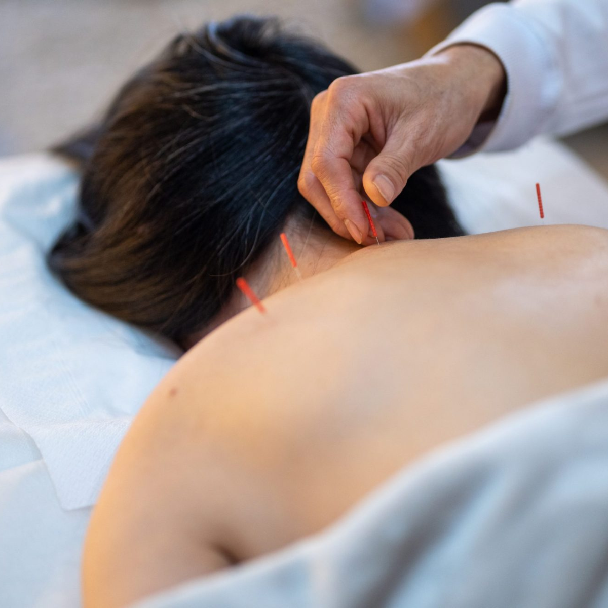 Acupuncture treatment at Monmouth Advanced Medicine