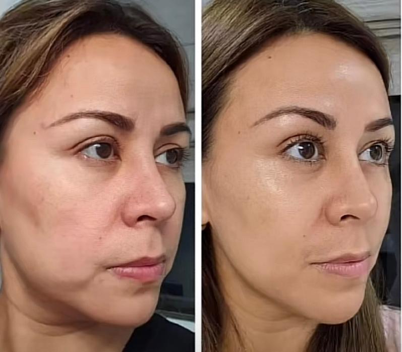 Resultado antes y después 1