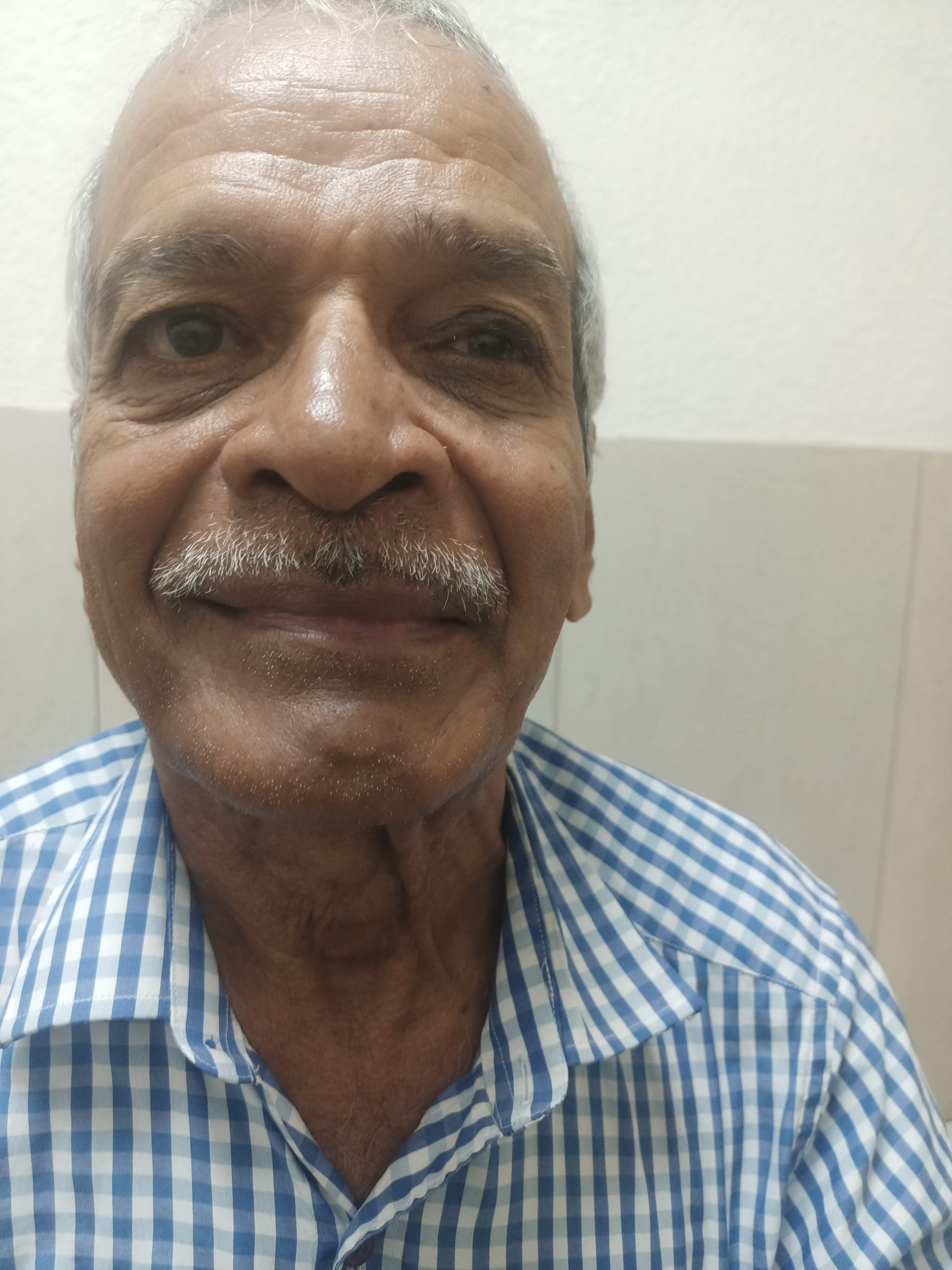 Facial Palsy (Bell's Palsy / Ardita) - after