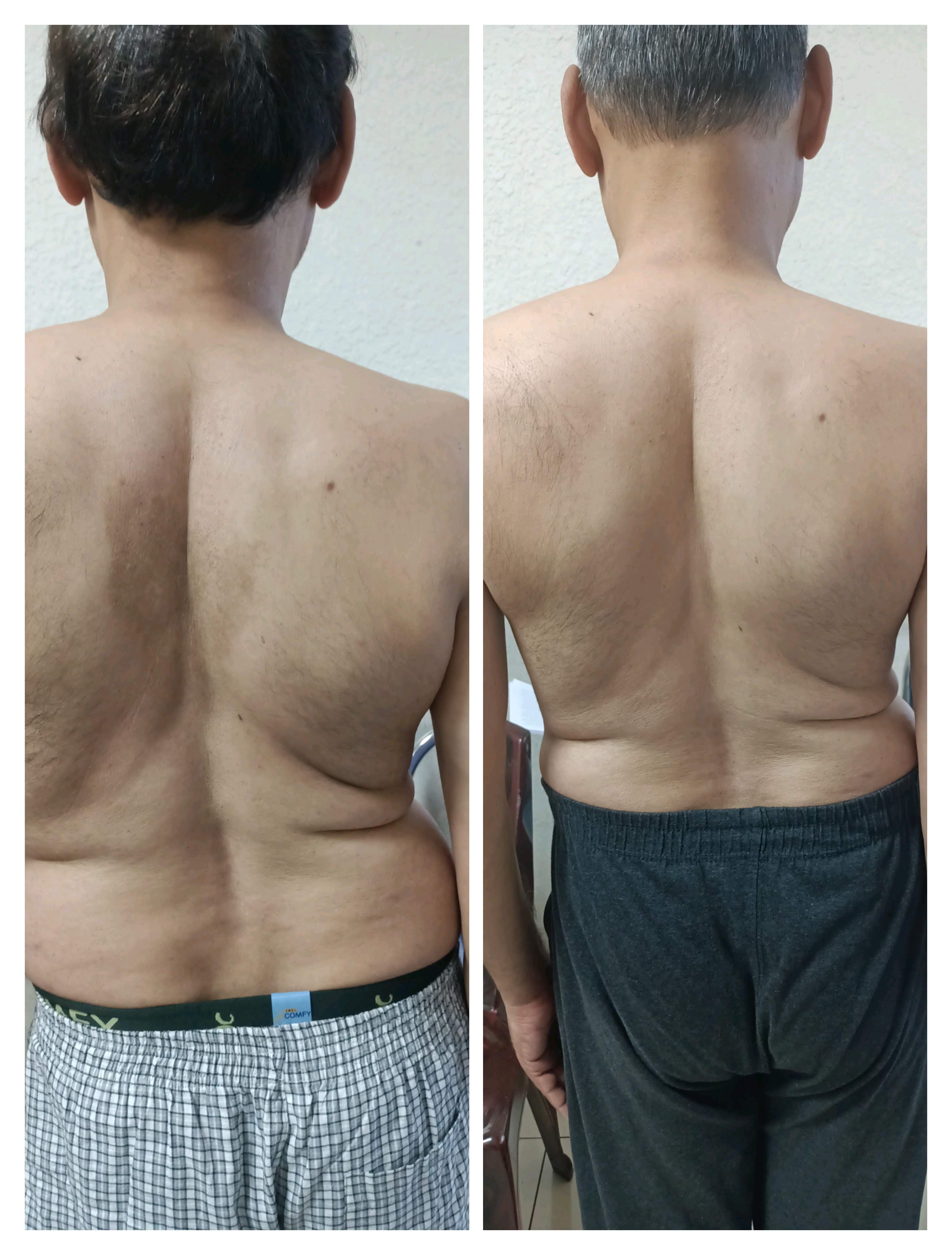 Scoliosis & Spine Realignment