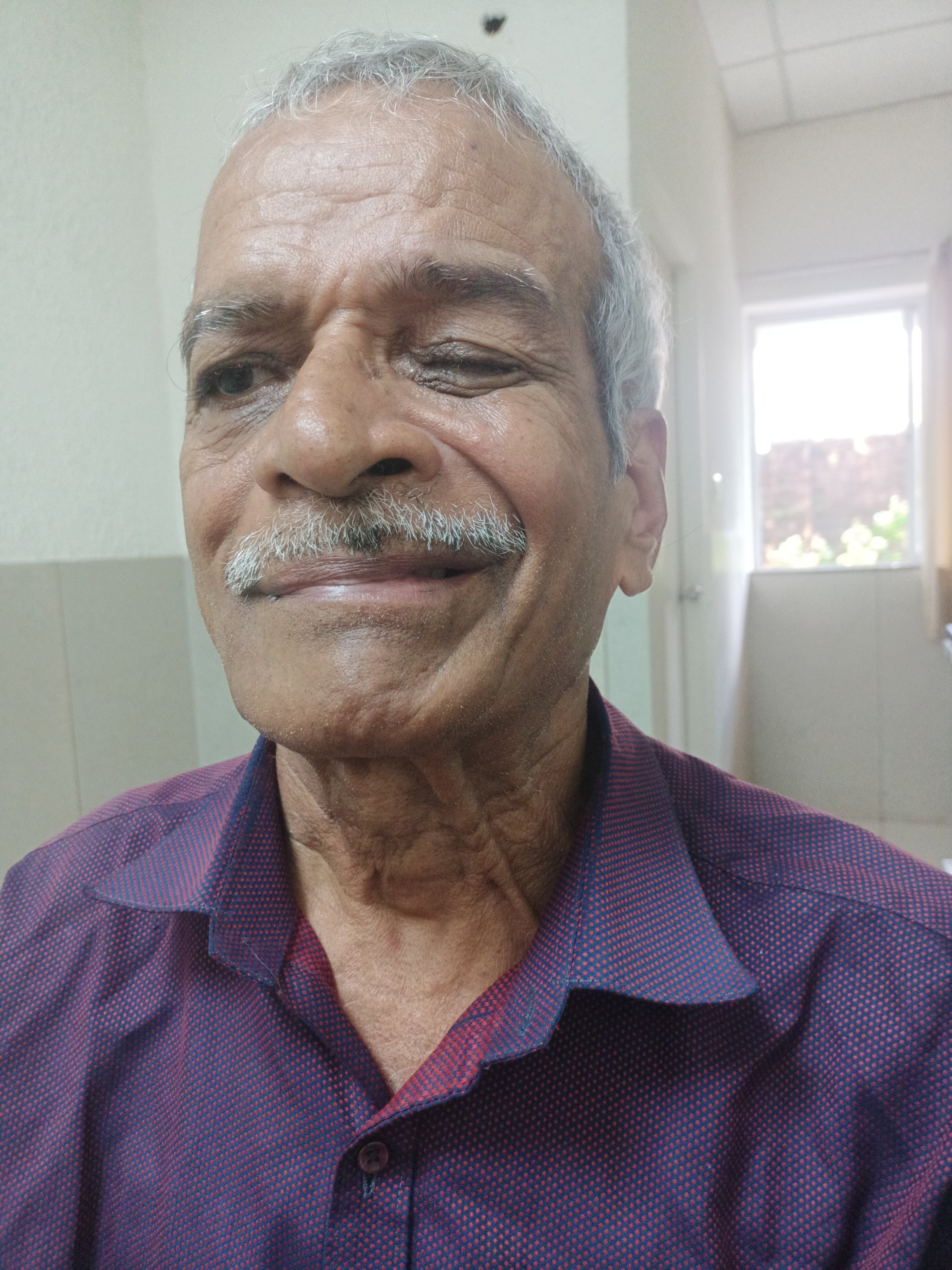 Facial Palsy (Bell's Palsy / Ardita) - before