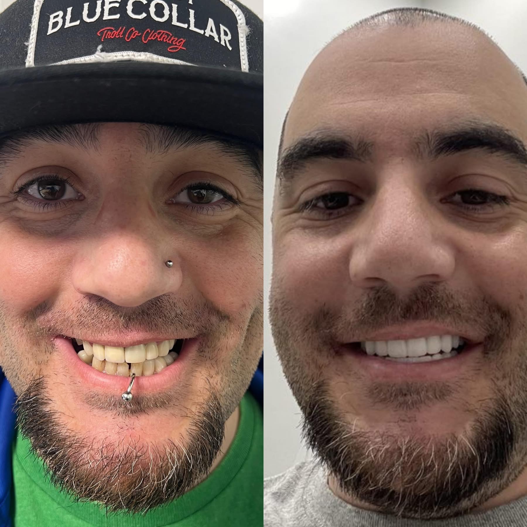 Patient before and after dental implants