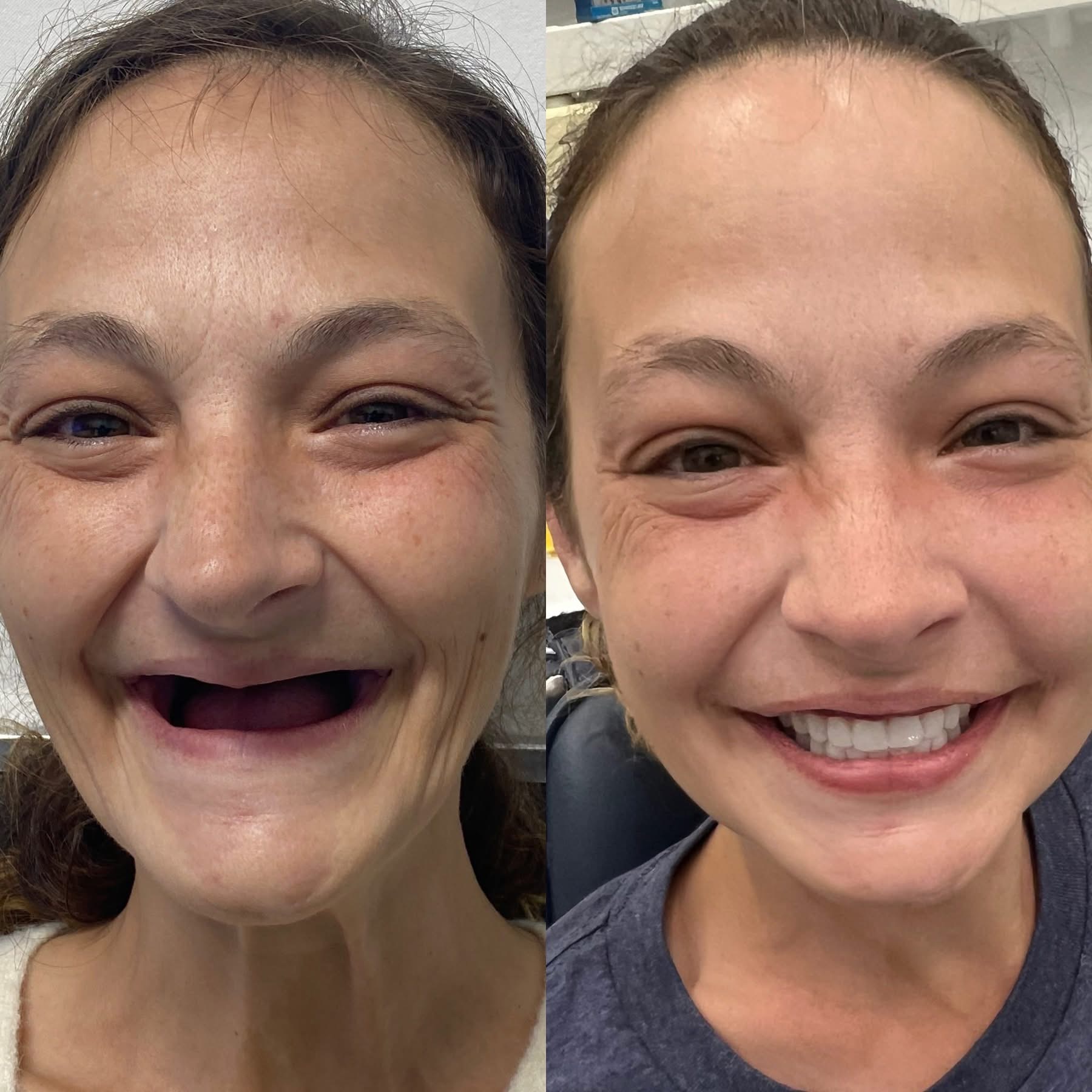 Patient before and after dental implants
