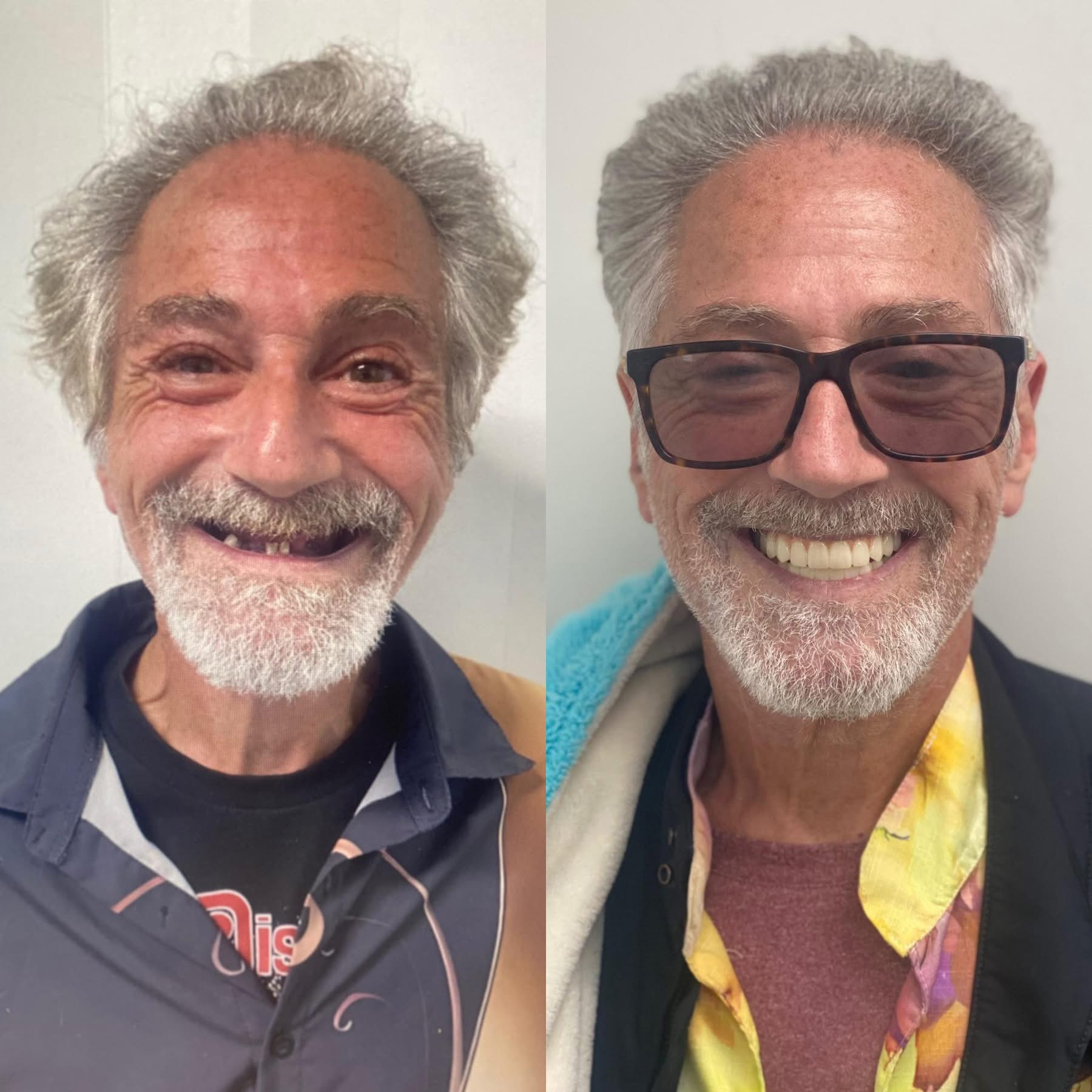 Patient before and after dental implants