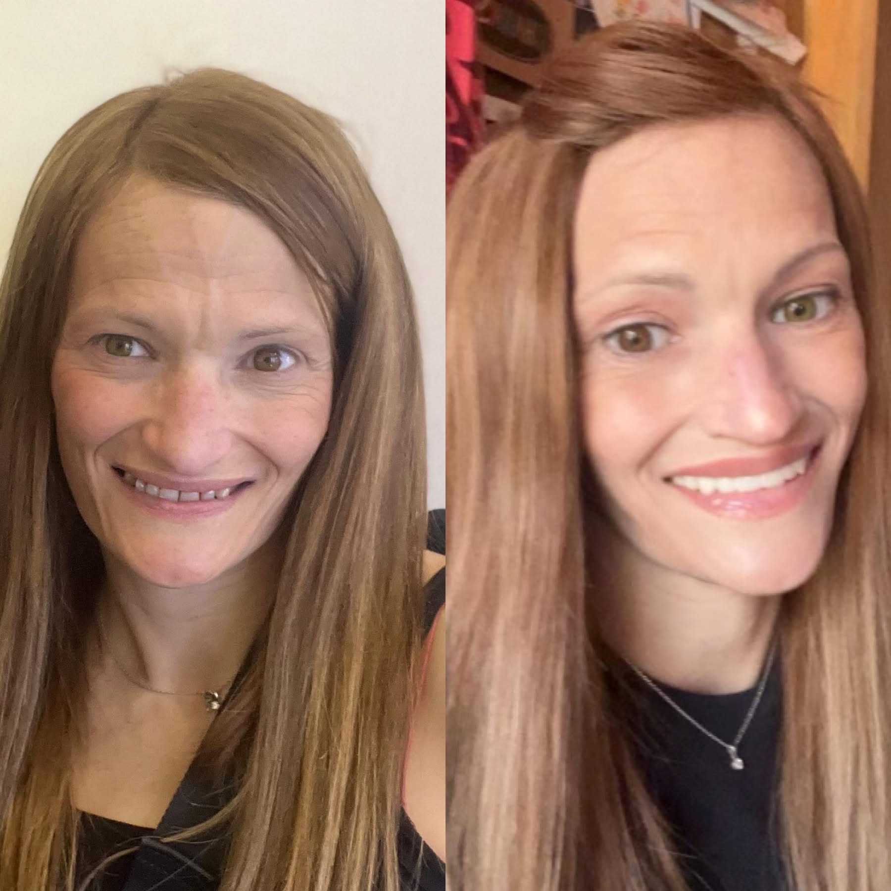 Patient before and after dental implants