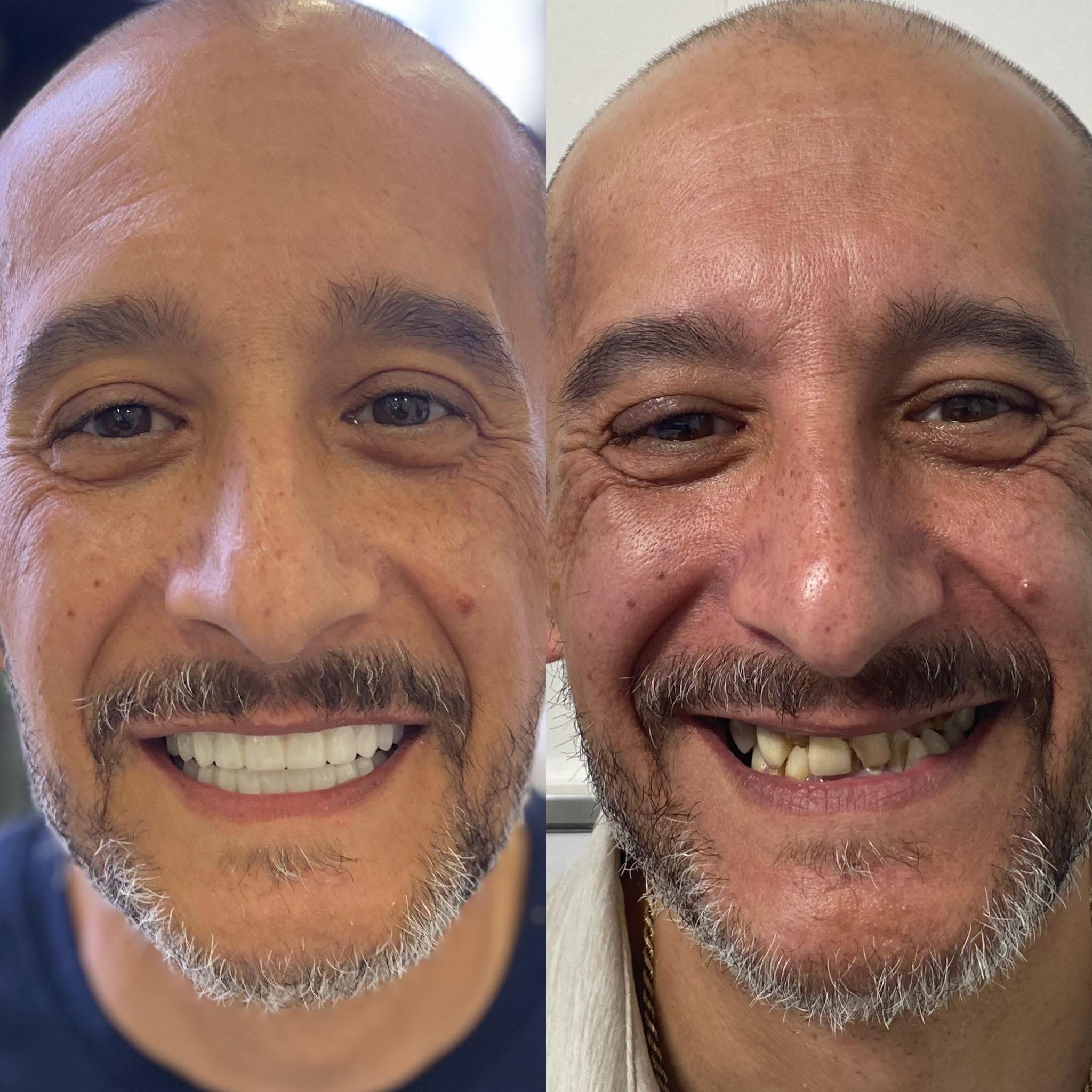 Patient before and after dental implants