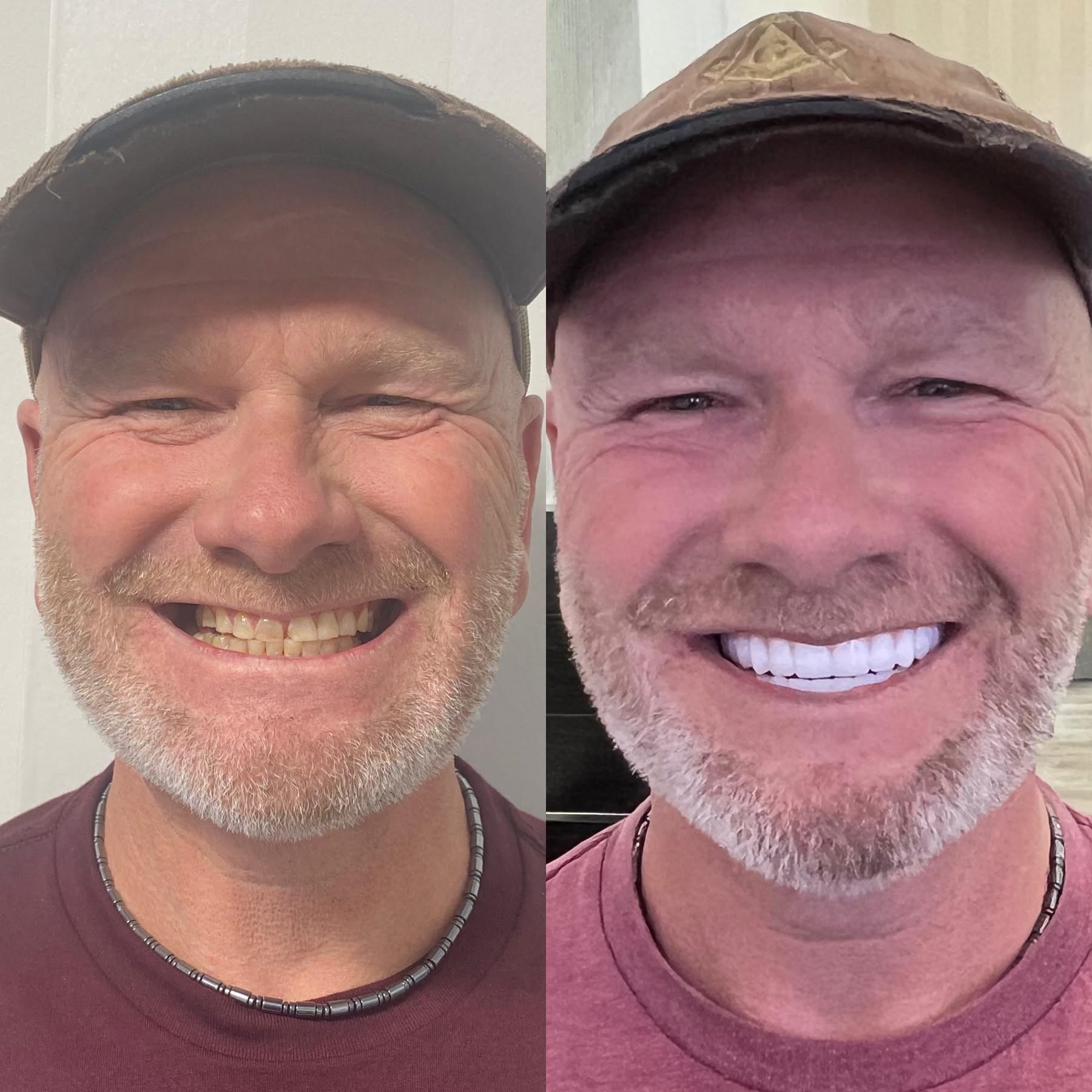 Patient before and after dental implants