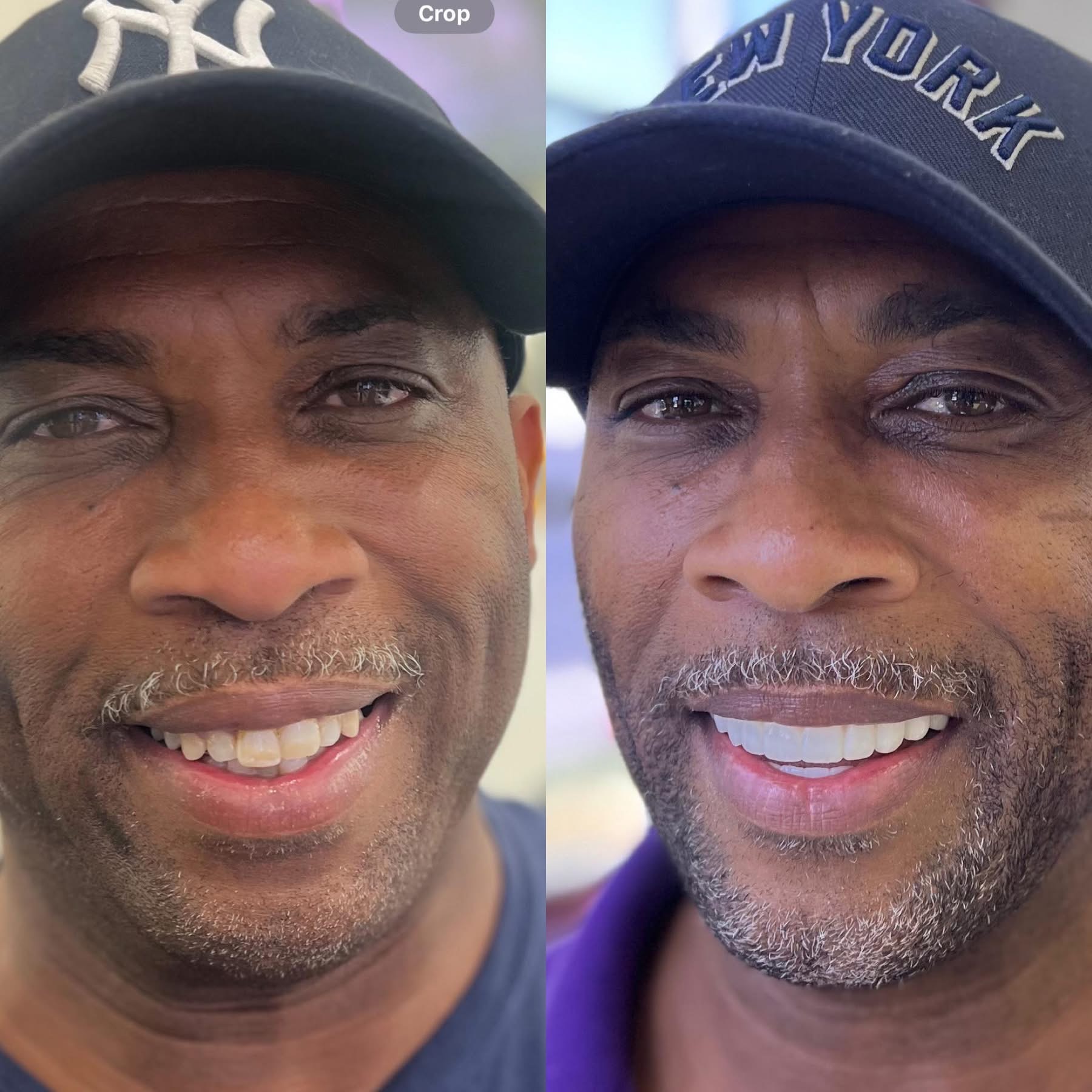 Patient before and after dental implants