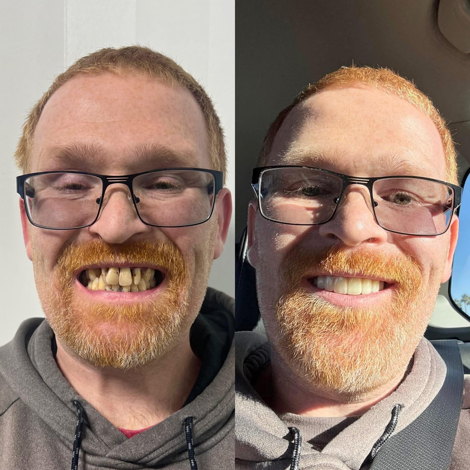 Patient before and after dental implants