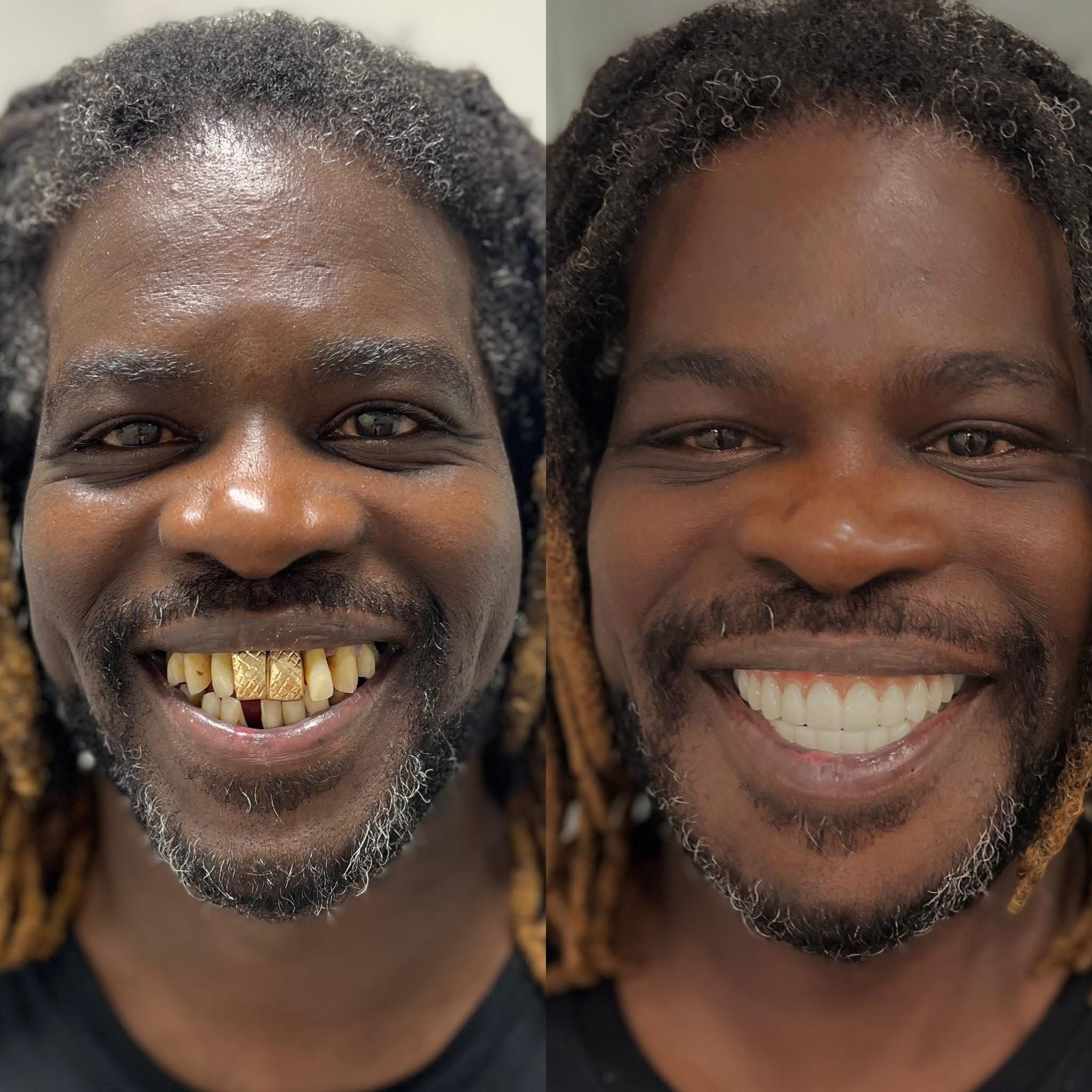 Patient before and after dental implants