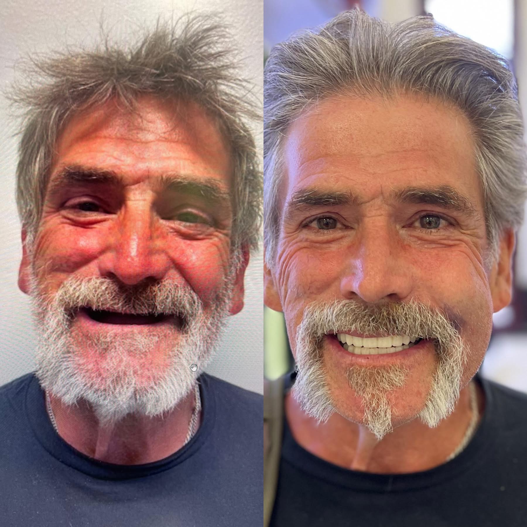 Patient before and after dental implants