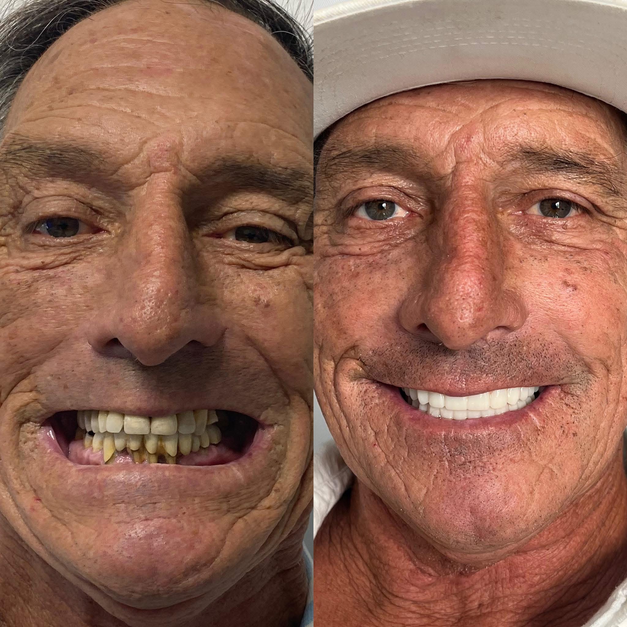 Patient before and after dental implants