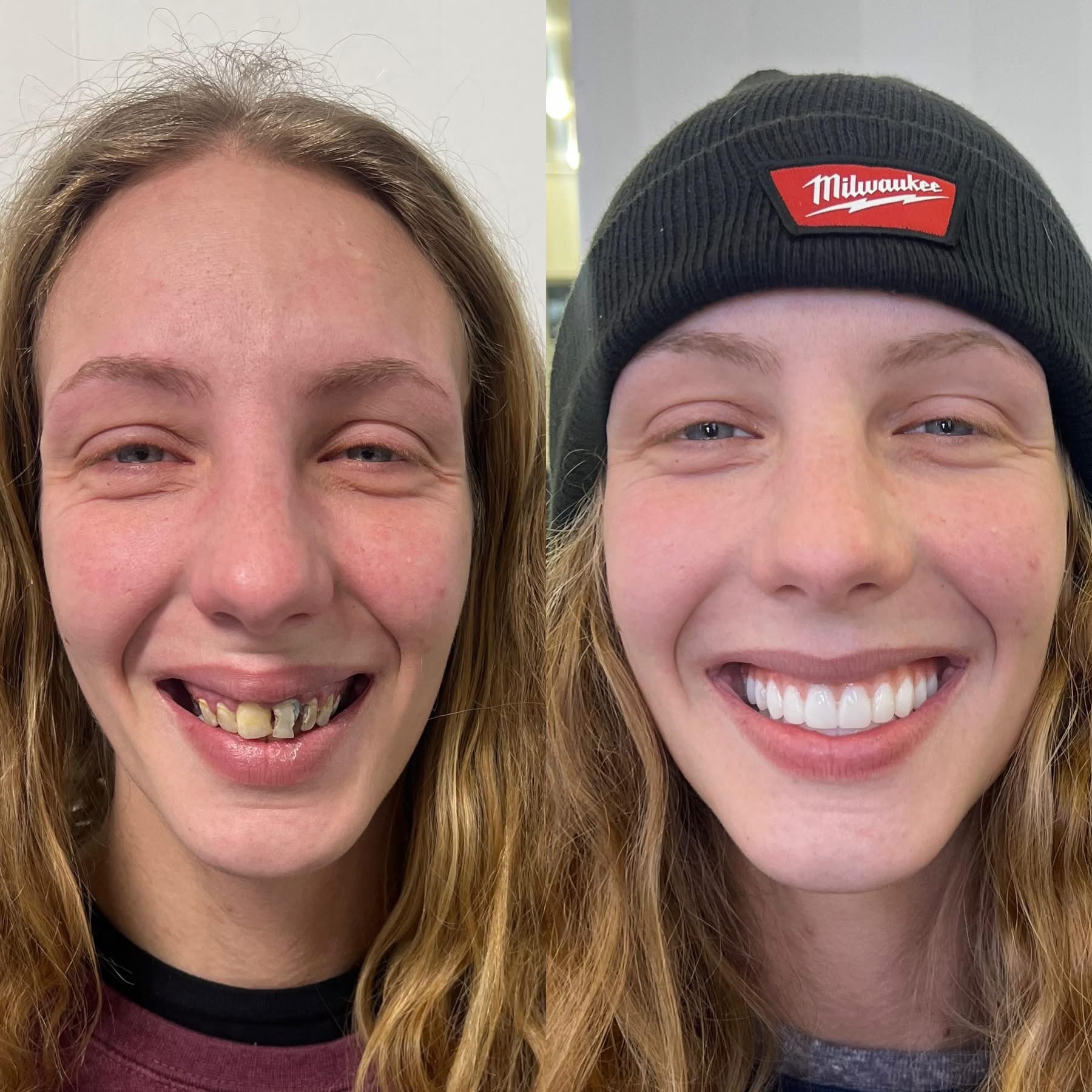 Patient before and after dental implants