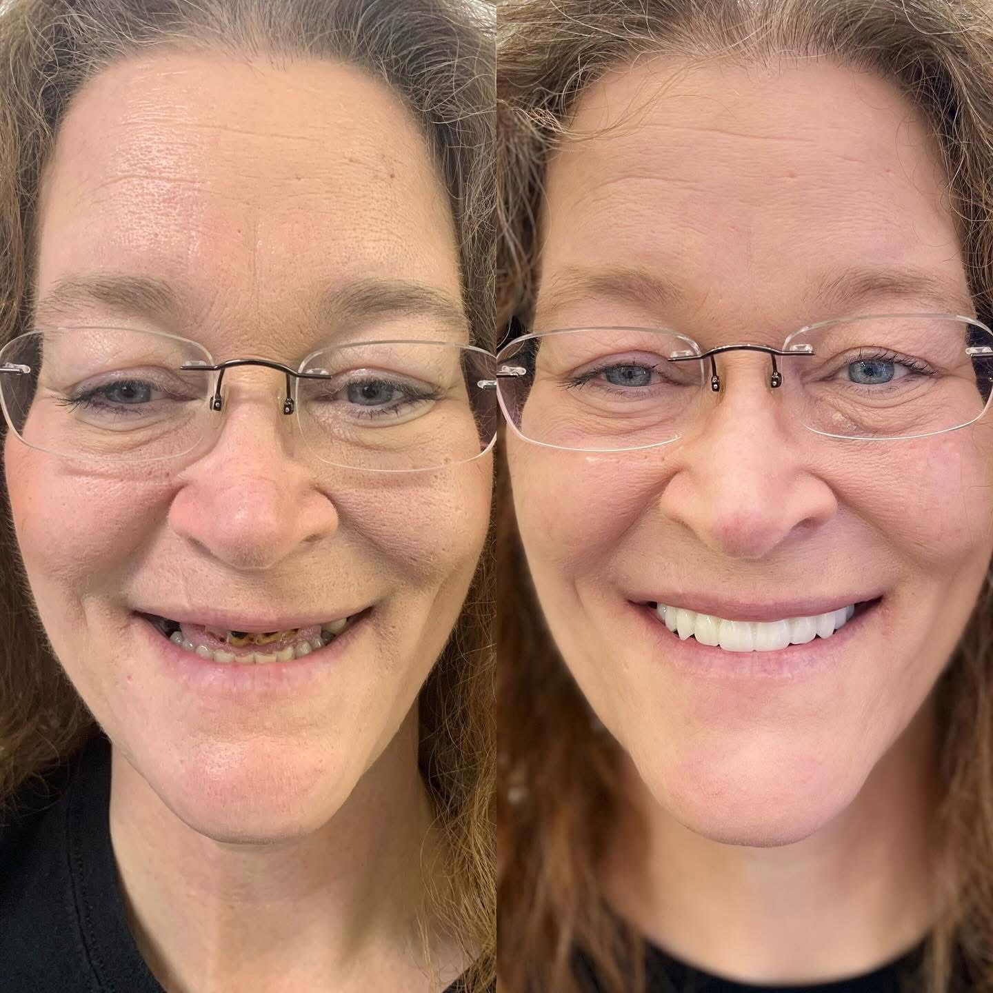 Patient before and after dental implants
