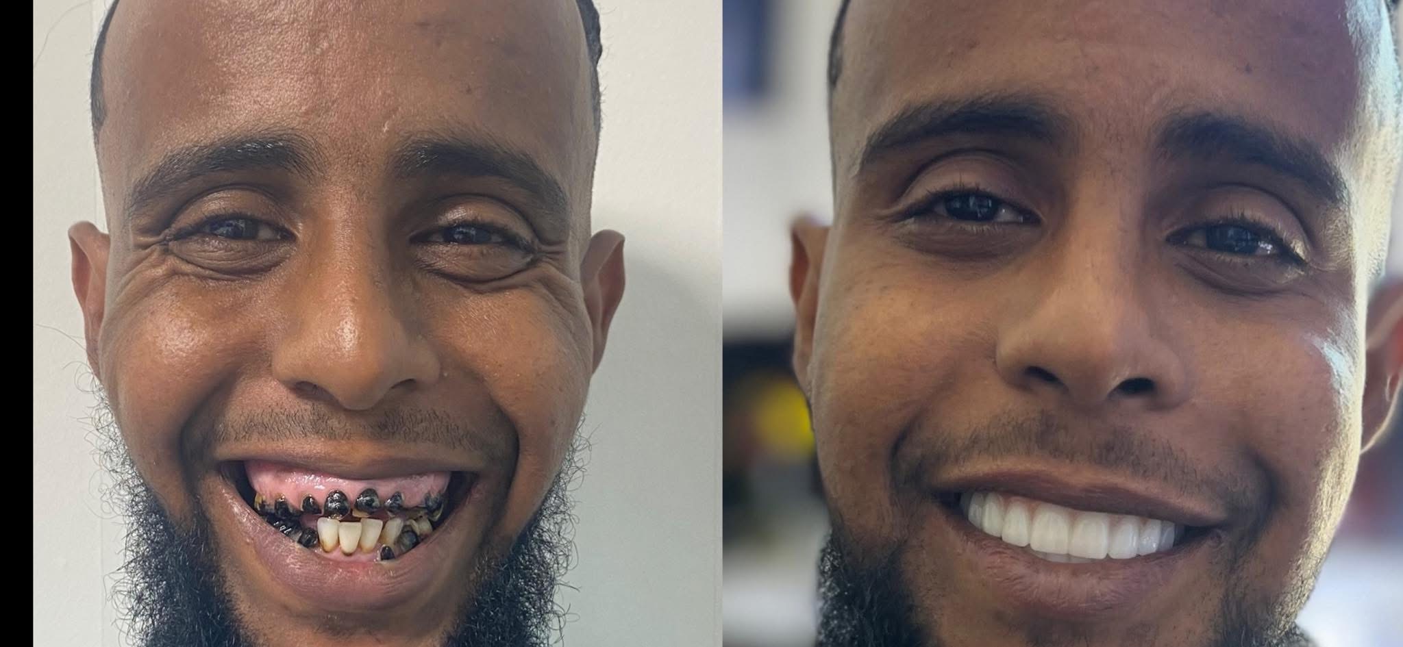 Patient before and after dental implants