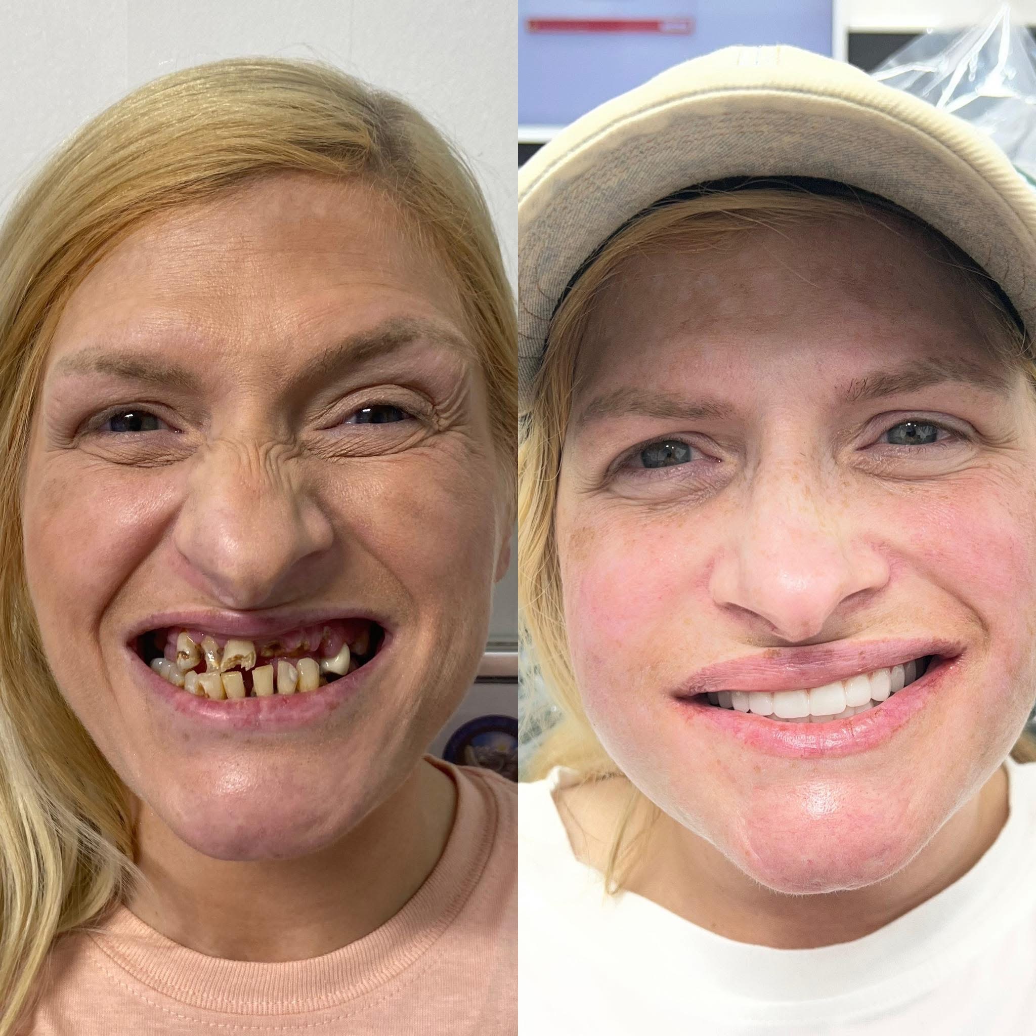 Patient before and after dental implants