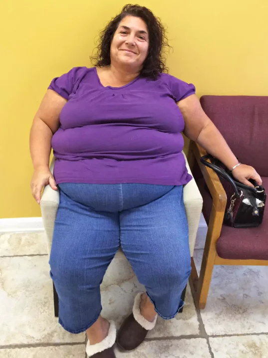 Emily weight loss before pic