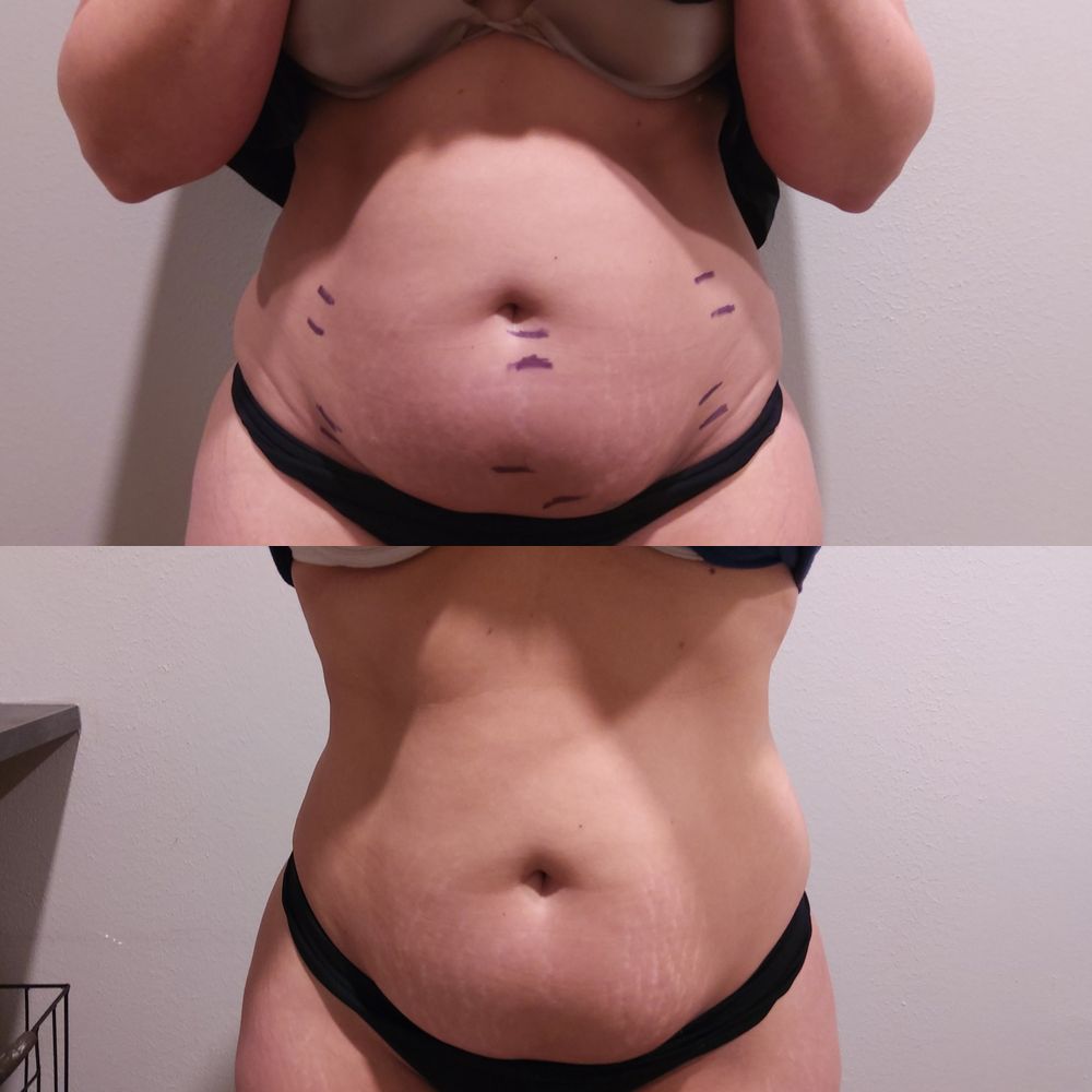 Client front view before and after, showing a smaller, smoother lower abdomen