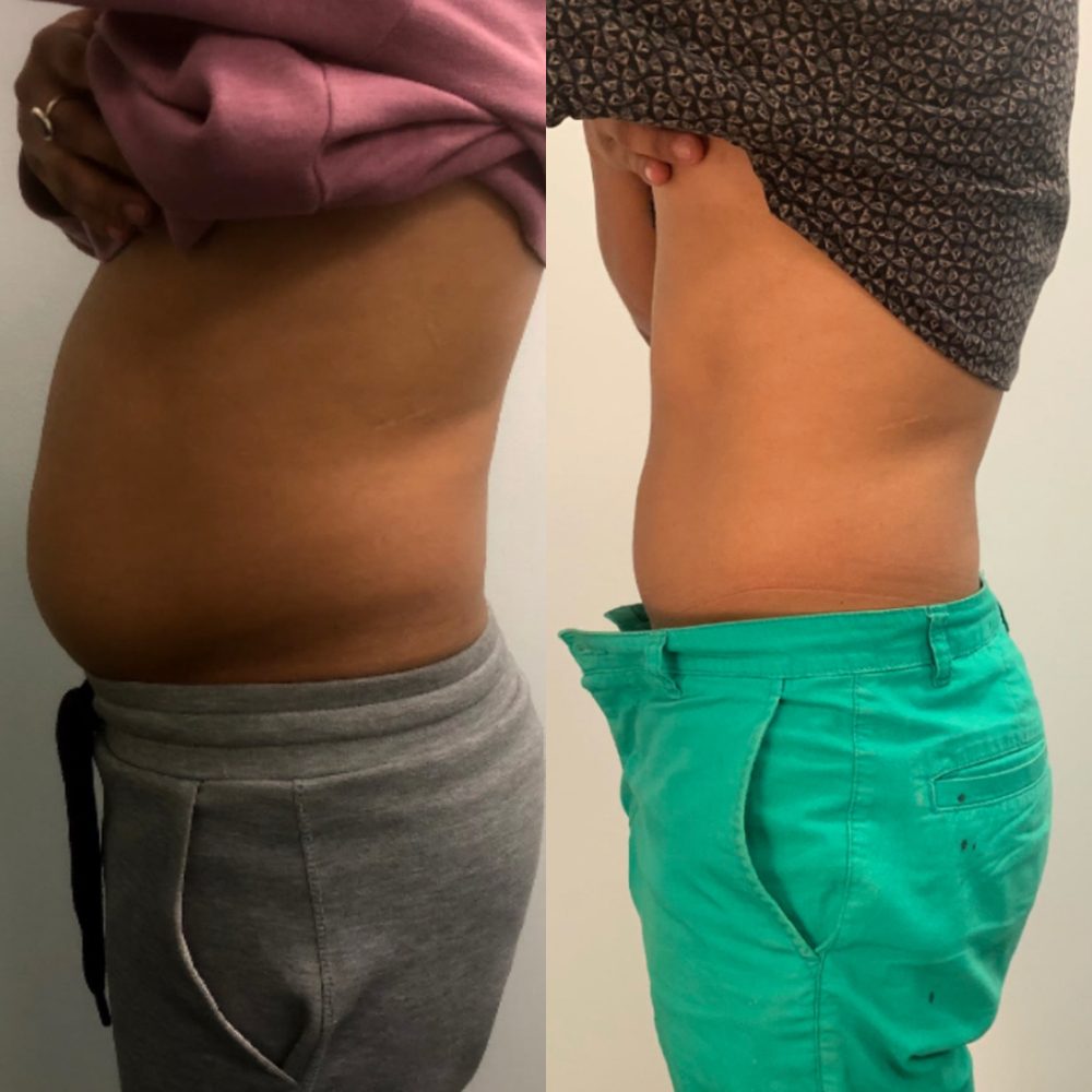 Client side profile before and after, showing a flatter stomach
