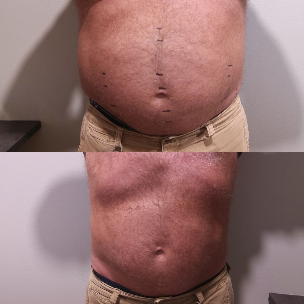 Male client front view before and after, showing a flatter abdomen