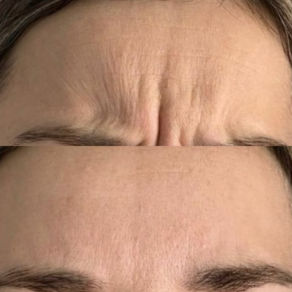 Frown lines between the brows before and after Tox