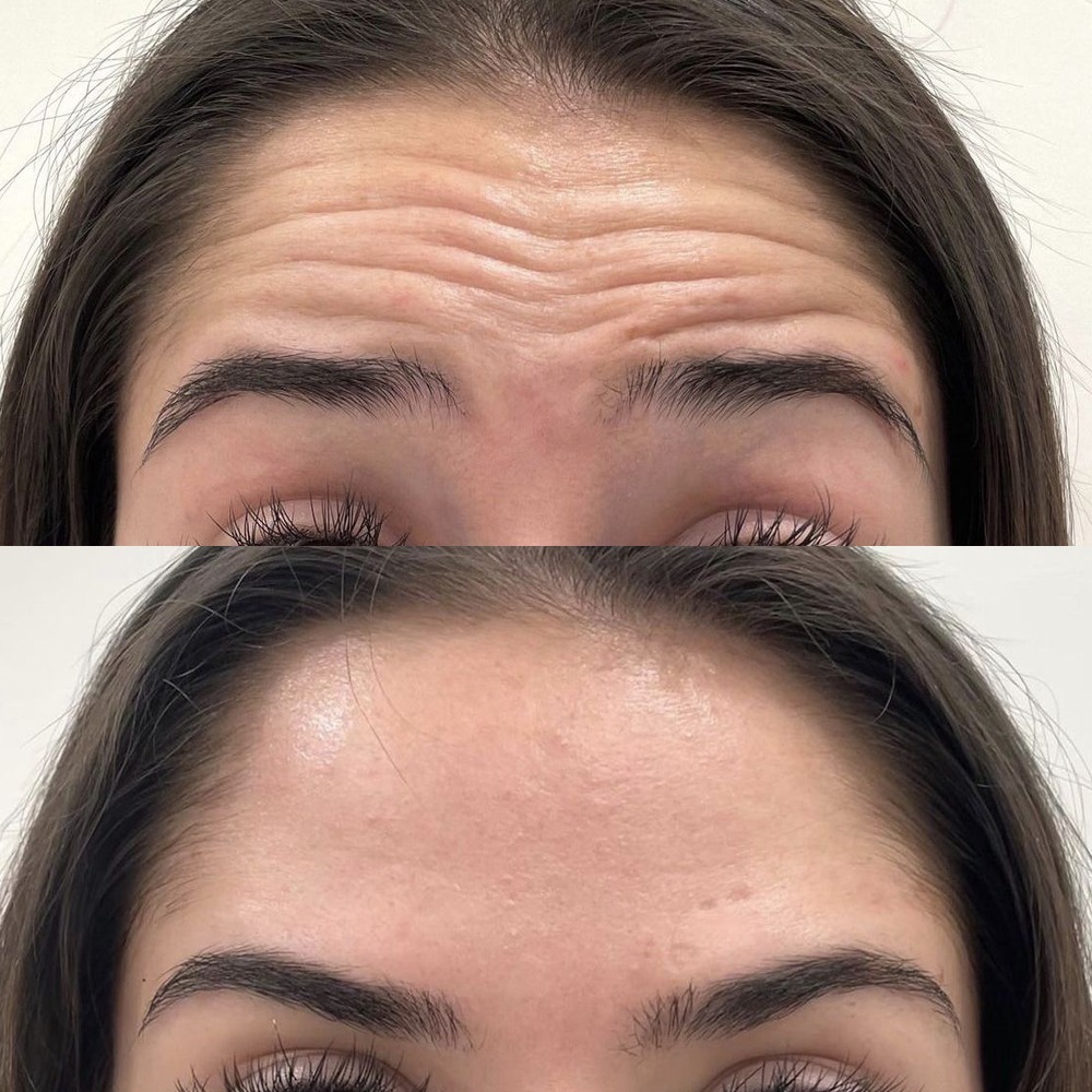 Forehead lines before and after Tox
