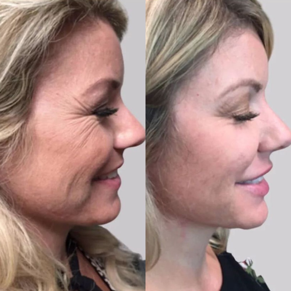 Side profile before and after Tox, showing softer lines at the outer eye