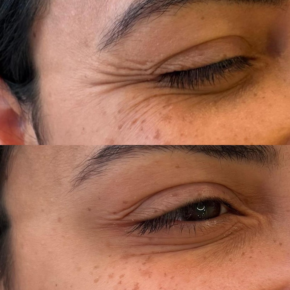 Close-up of the eye area before and after Tox, showing softer crow's feet