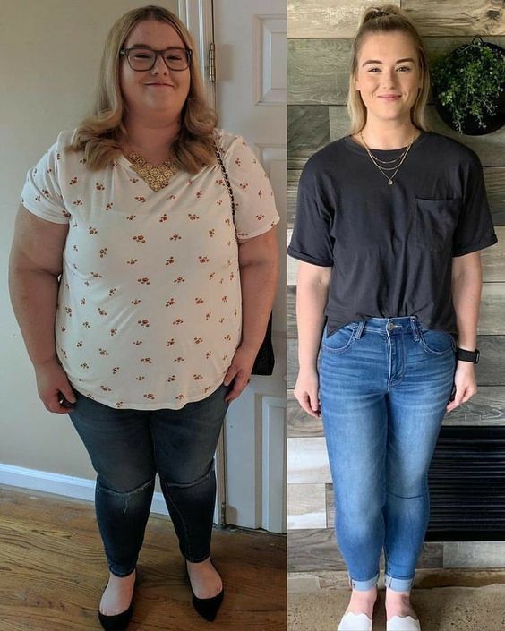 Patient before and after weight loss transformation