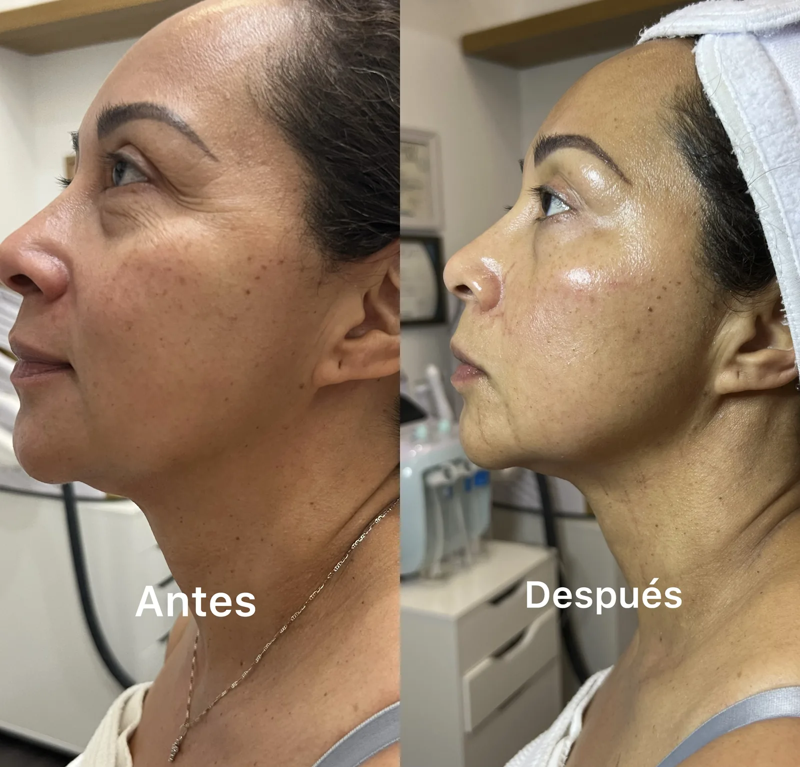 Before and after Morpheus8 for neck skin laxity