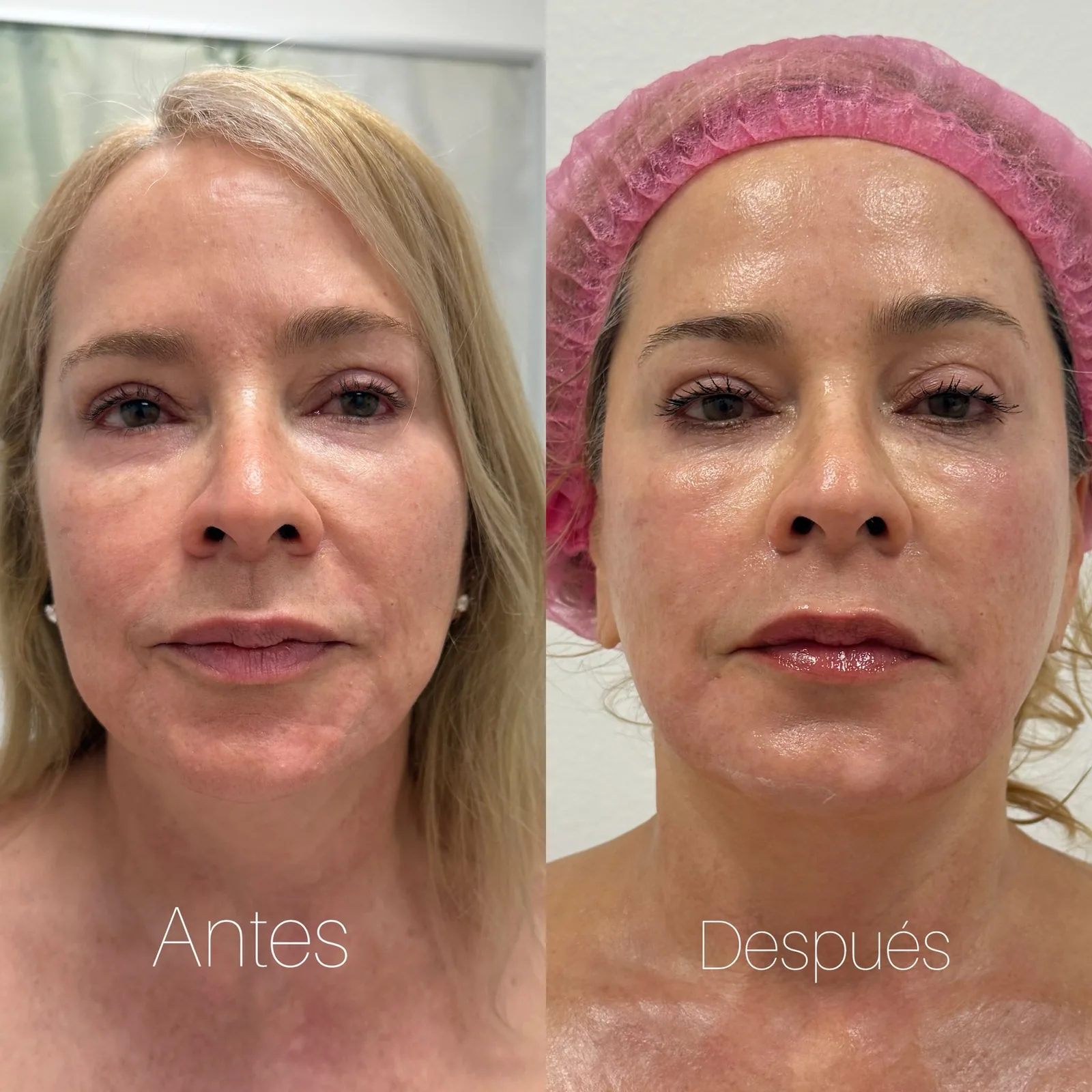 Before and after HydraFacial glow treatment