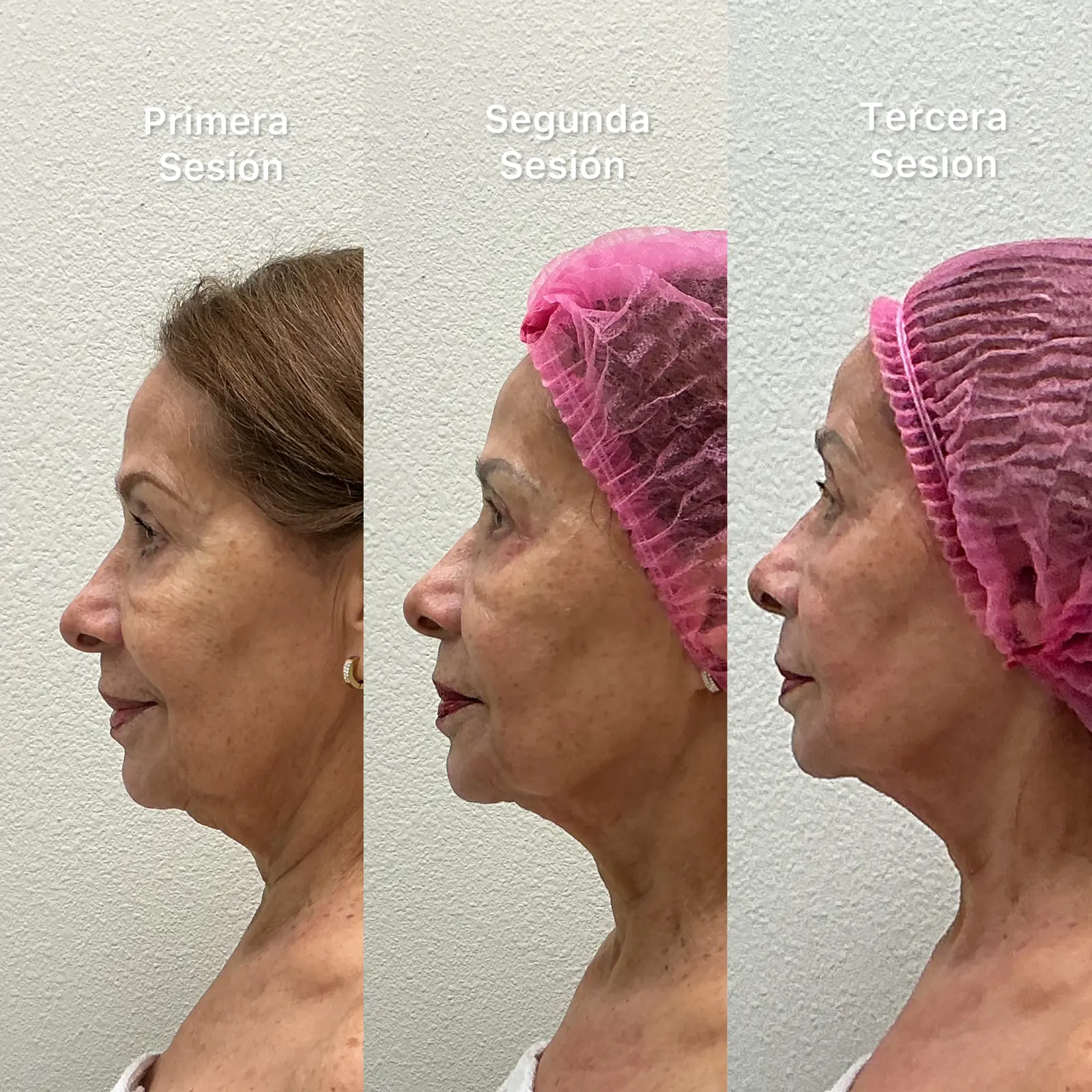 Morpheus8 skin laxity progress across 3 sessions