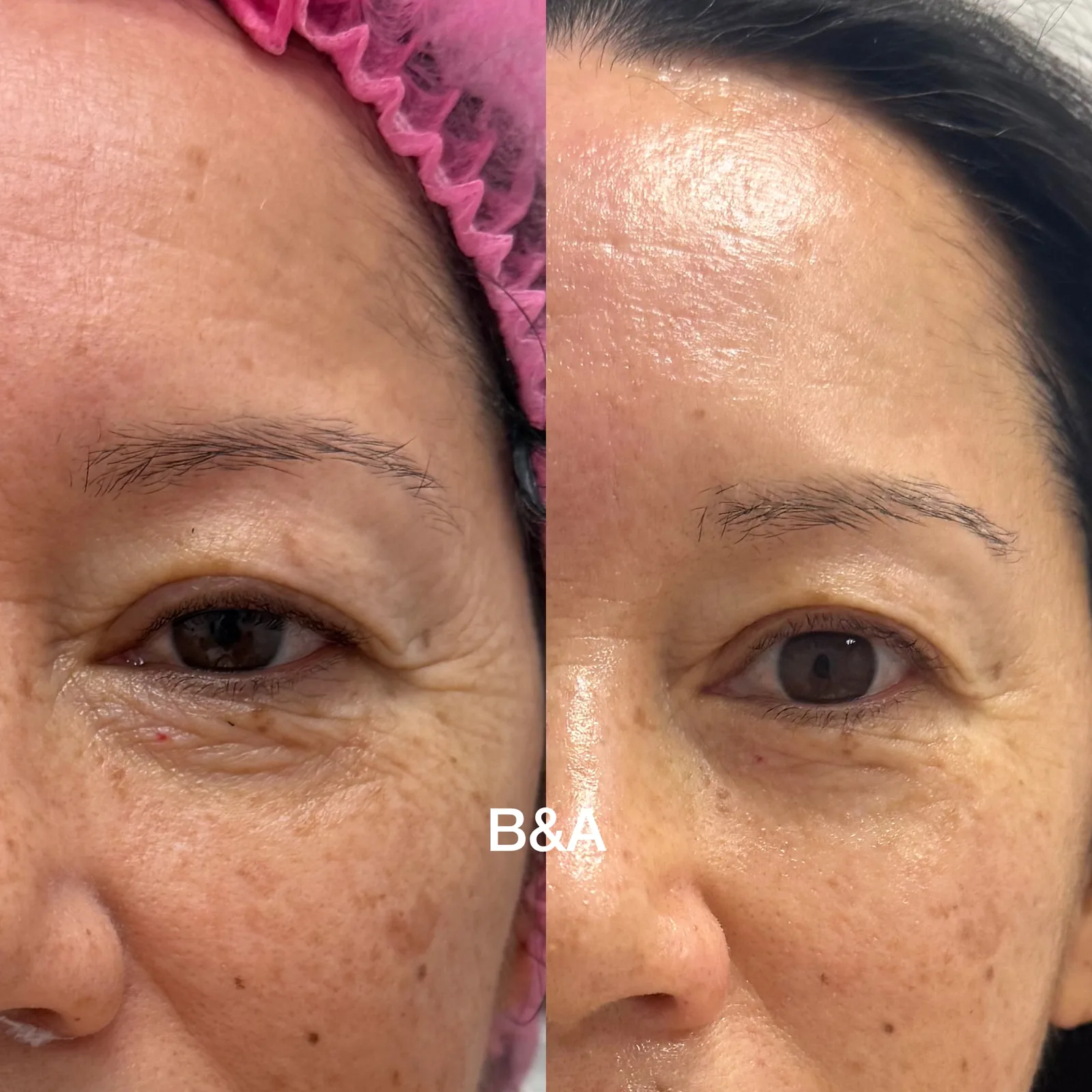Before and after treatment for fine lines