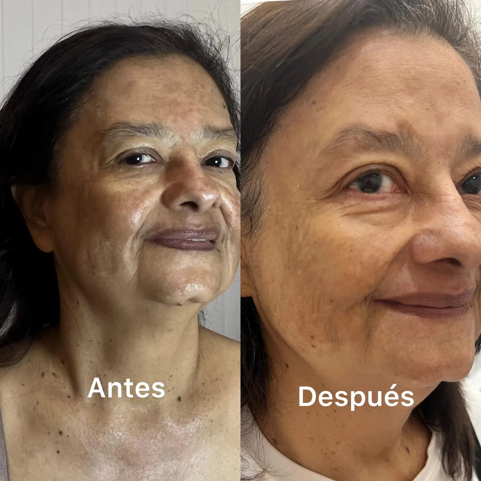 Before and after IPL treatment for dark spots