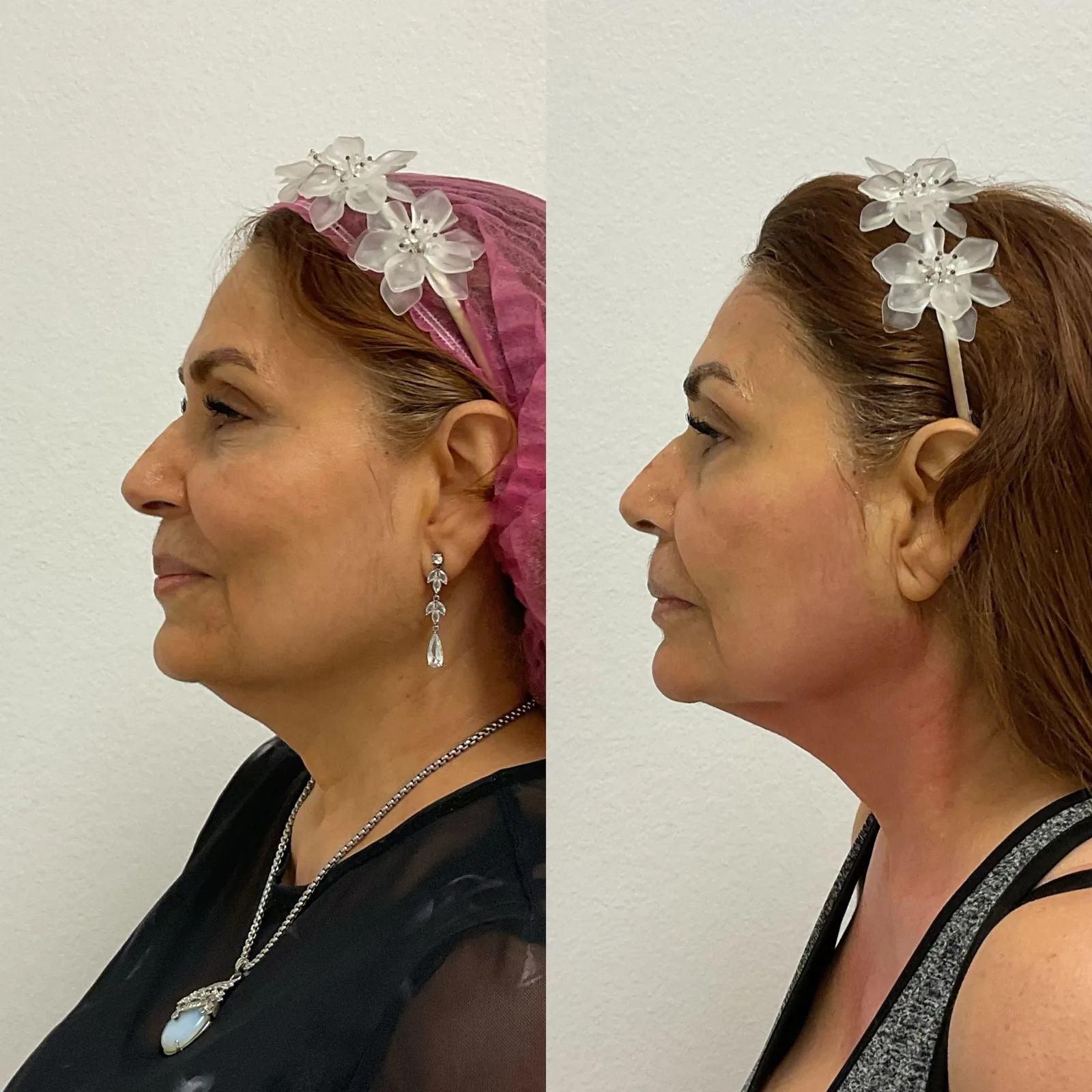 Before and after Morpheus8 for skin laxity