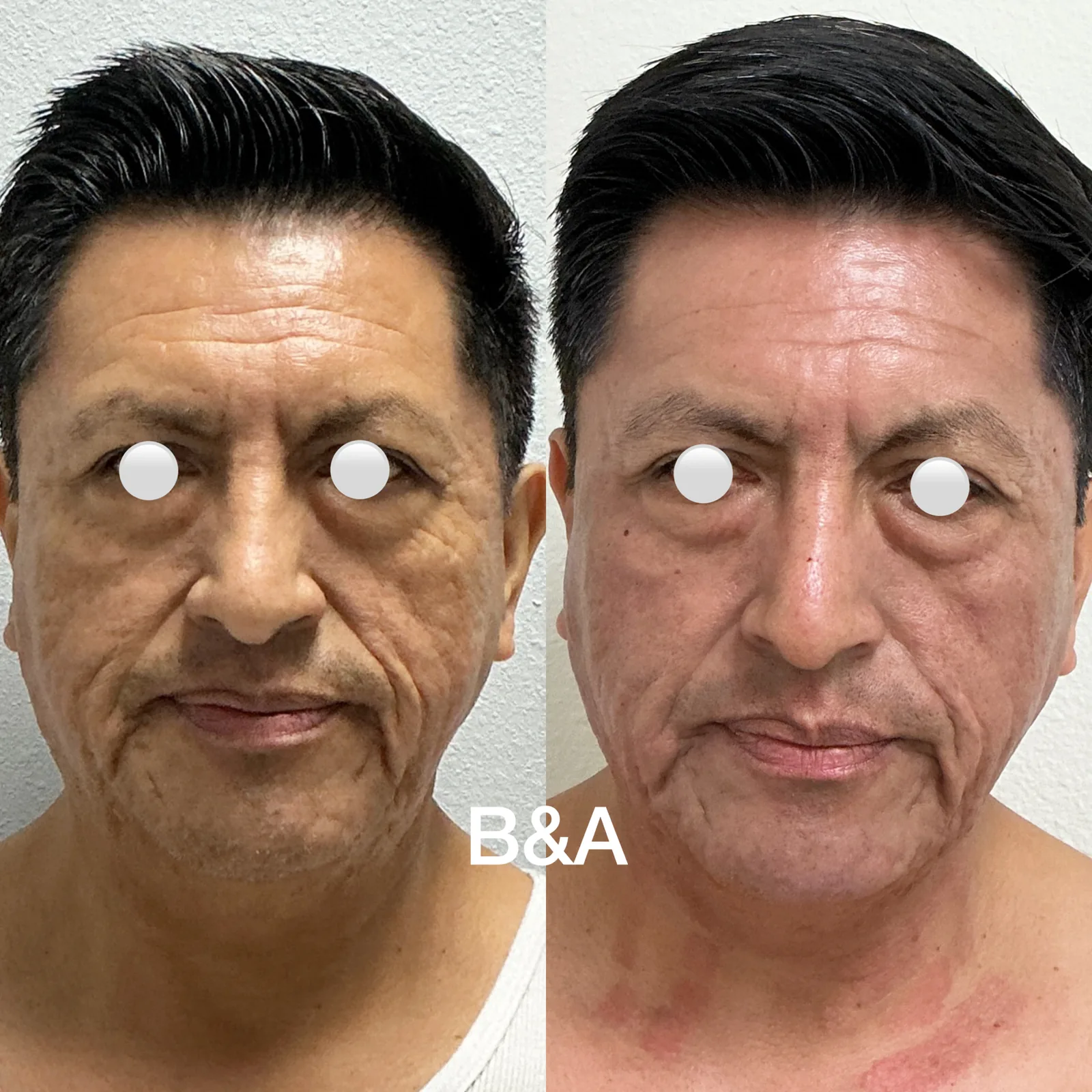 Before and after Morpheus8 for acne scars and wrinkles