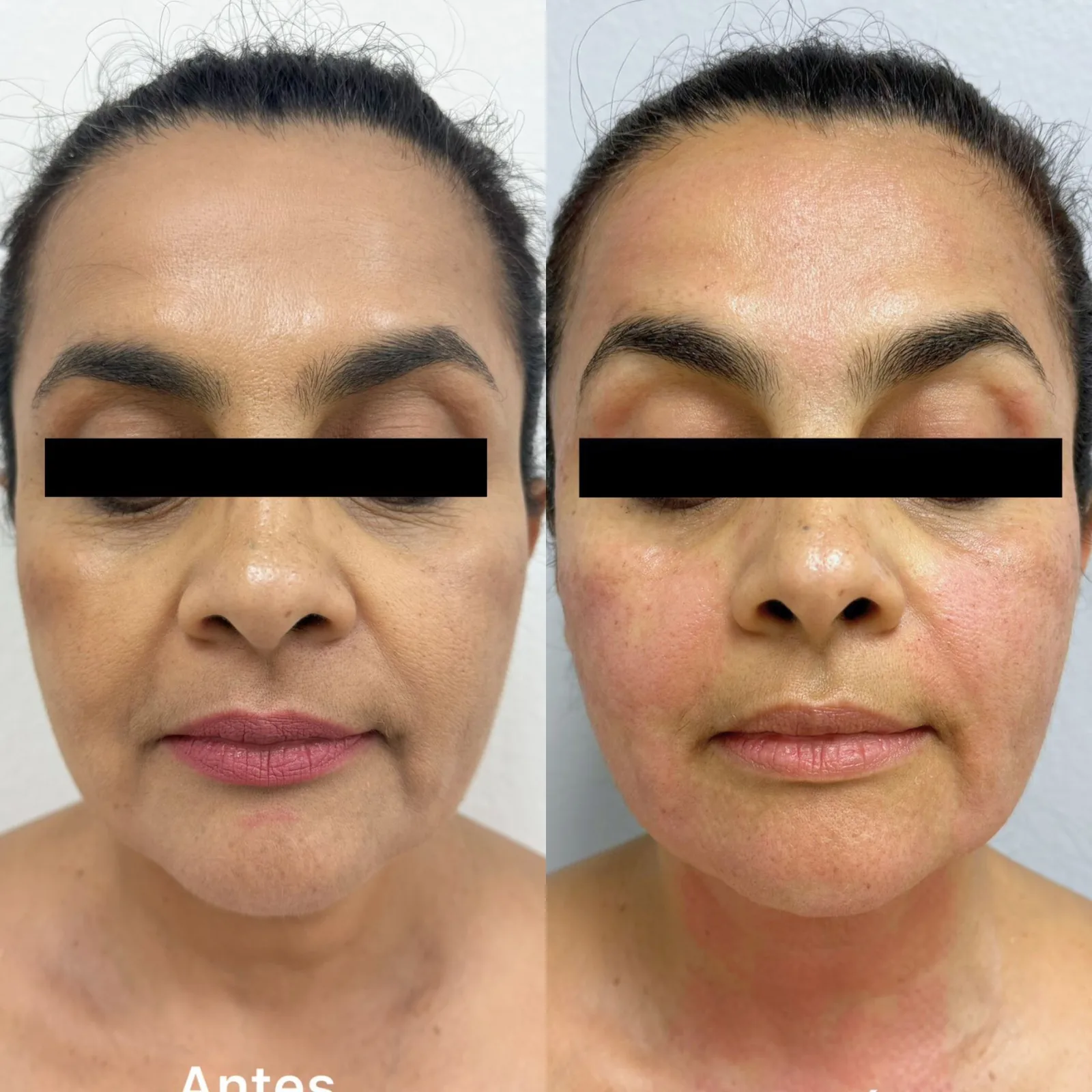 Before and after Morpheus8 for skin laxity and fine lines