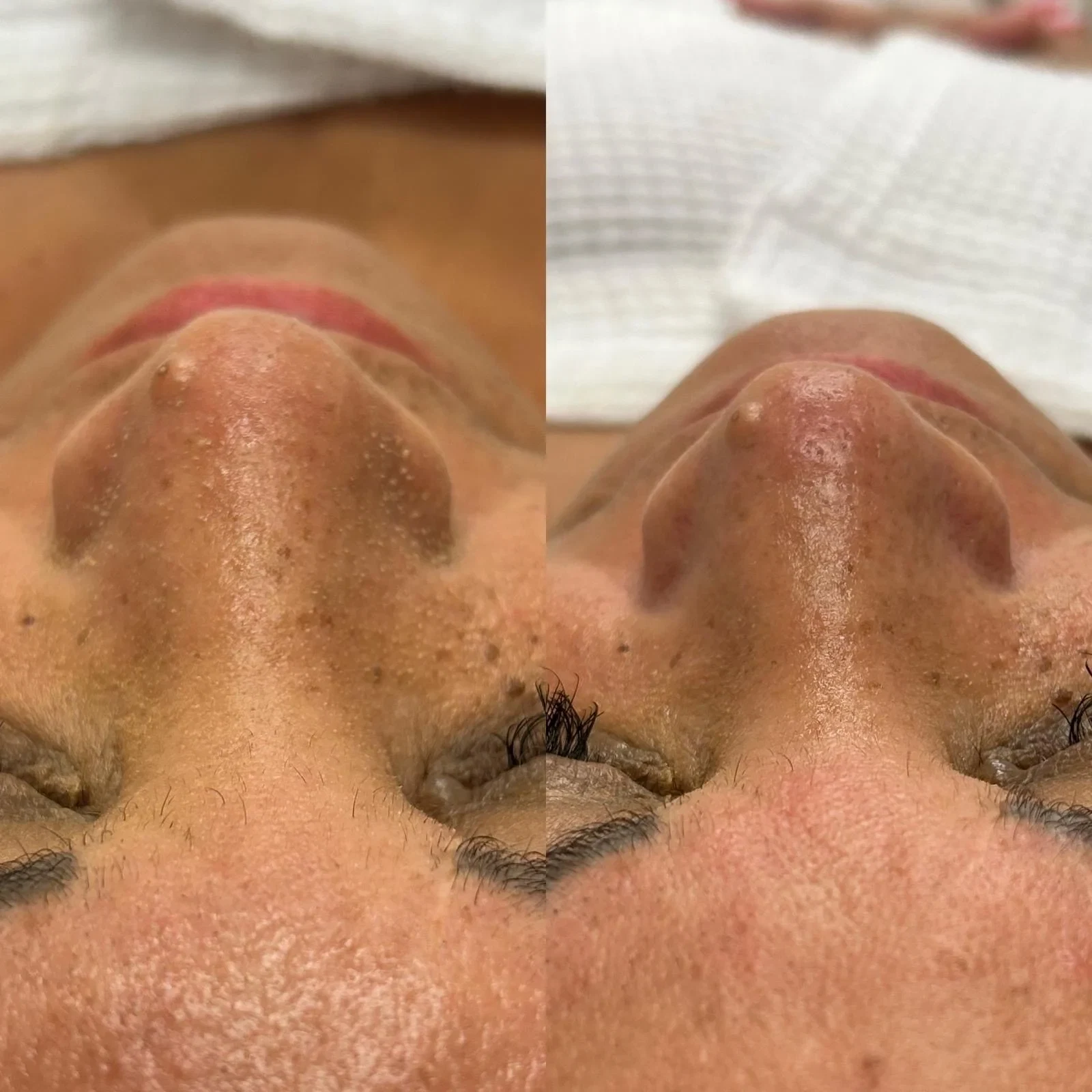 Before and after HydraFacial for hydration