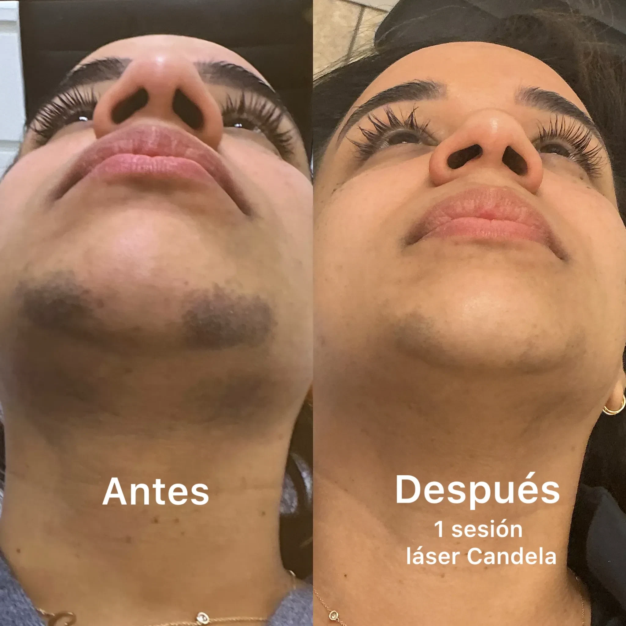 Before and after laser hair removal for unwanted hair and dark spots